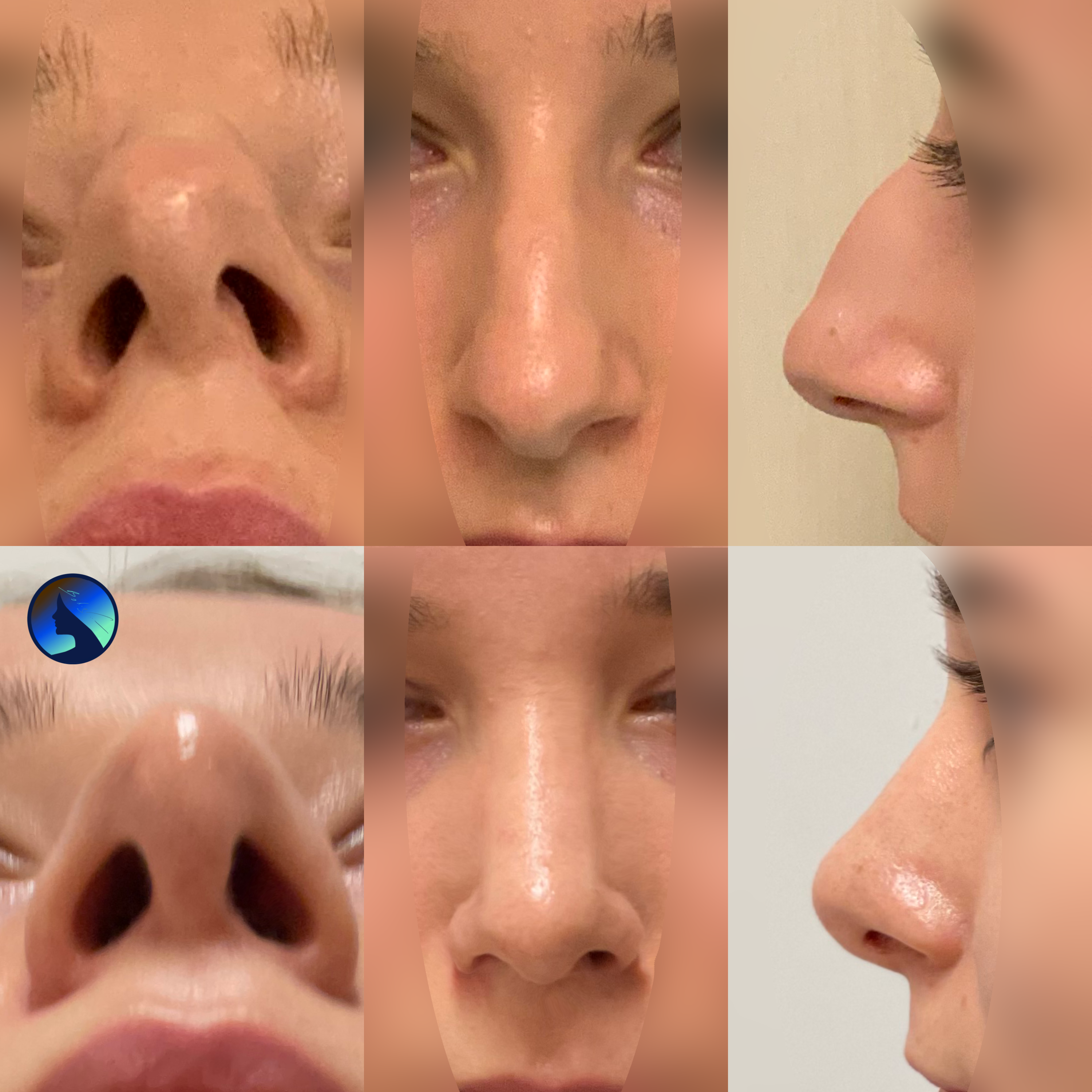 St. Valentine’s Rhinoplasty