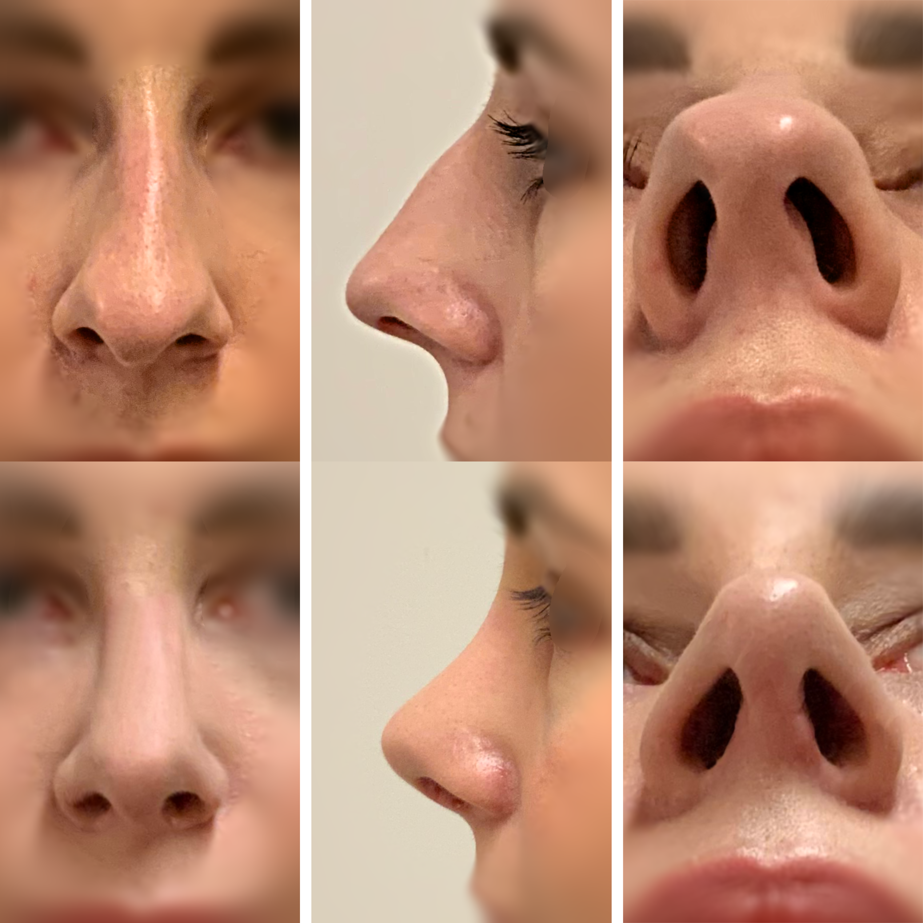 Template Rhinoplasty 2