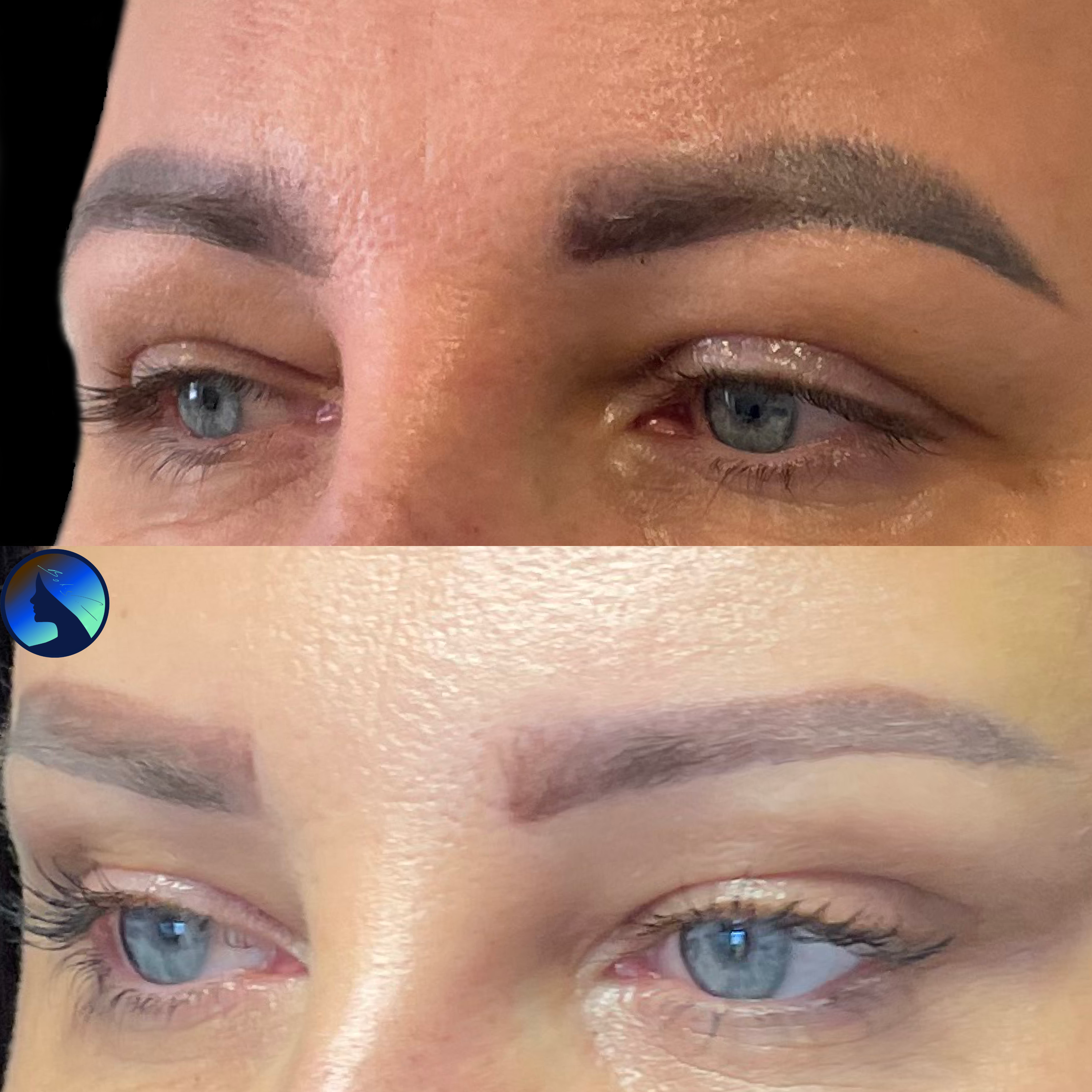 The brow temporal brow lift