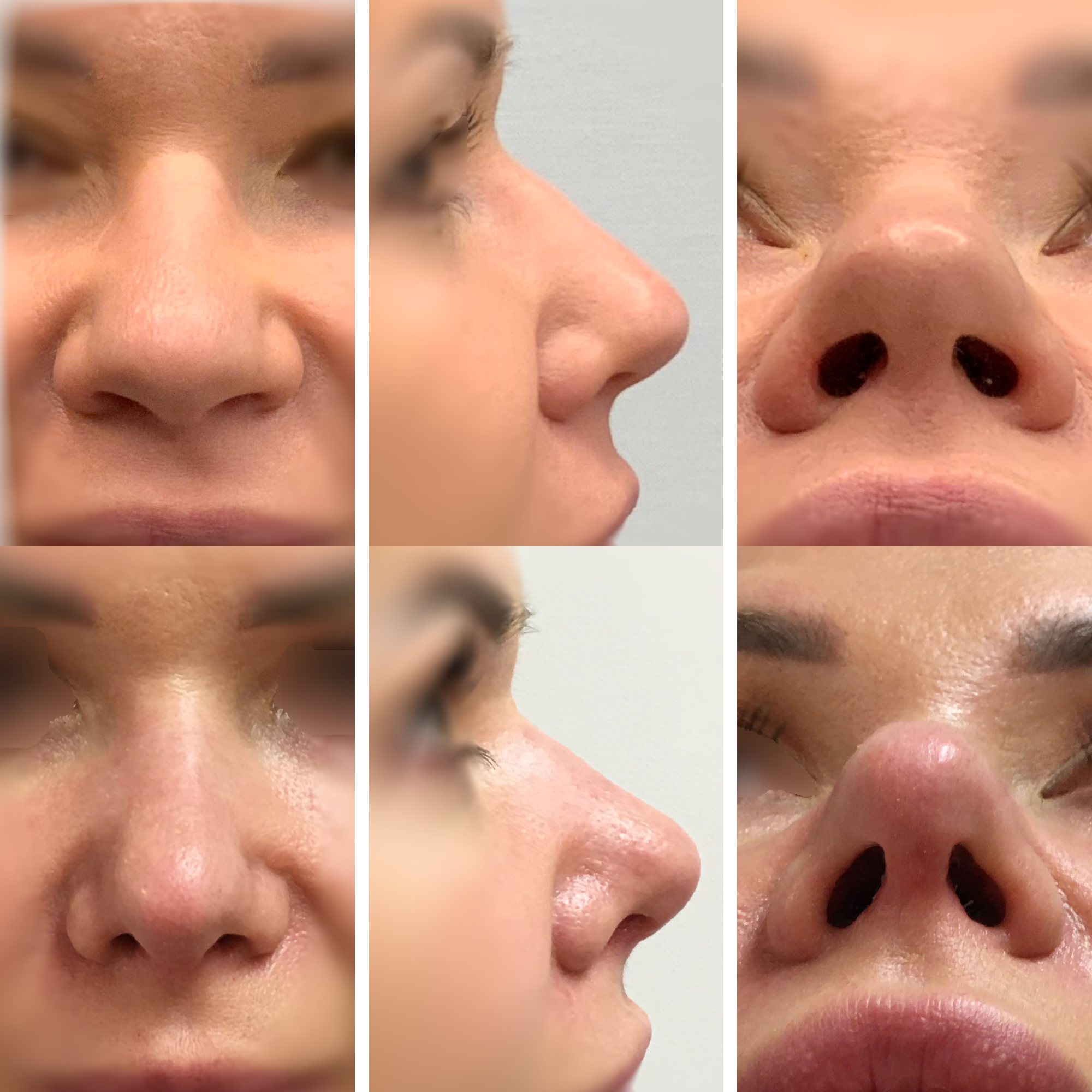 Wtórna korekta nosa