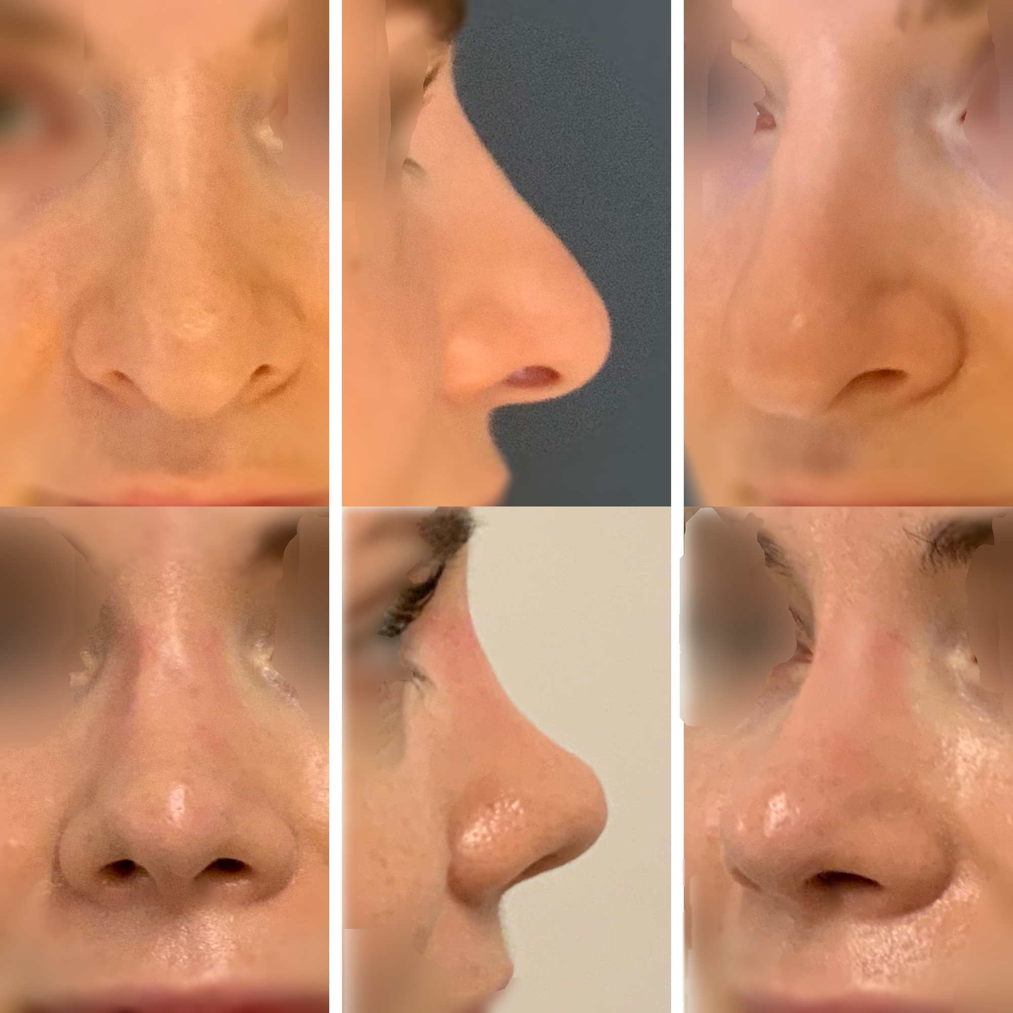 Wtórna korekta nosa