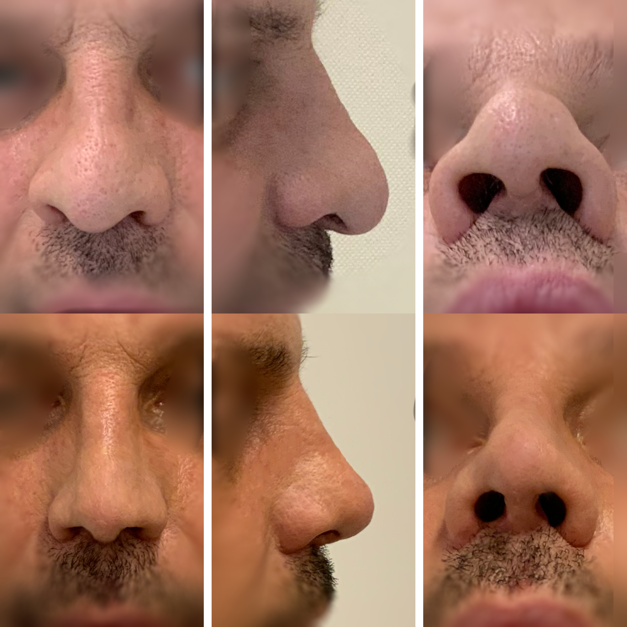 Wtórna korekta nosa