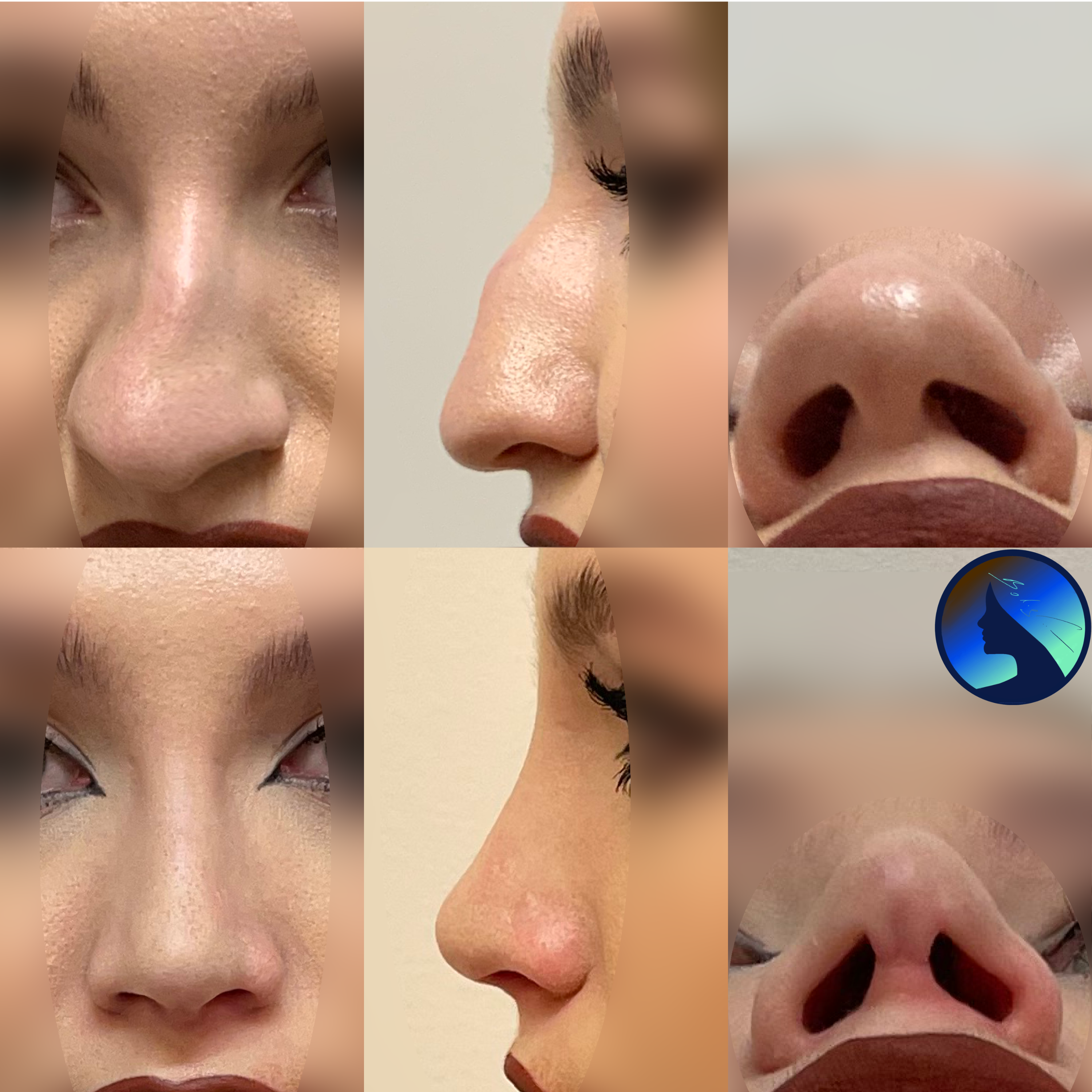 an amazing rhinoplasty