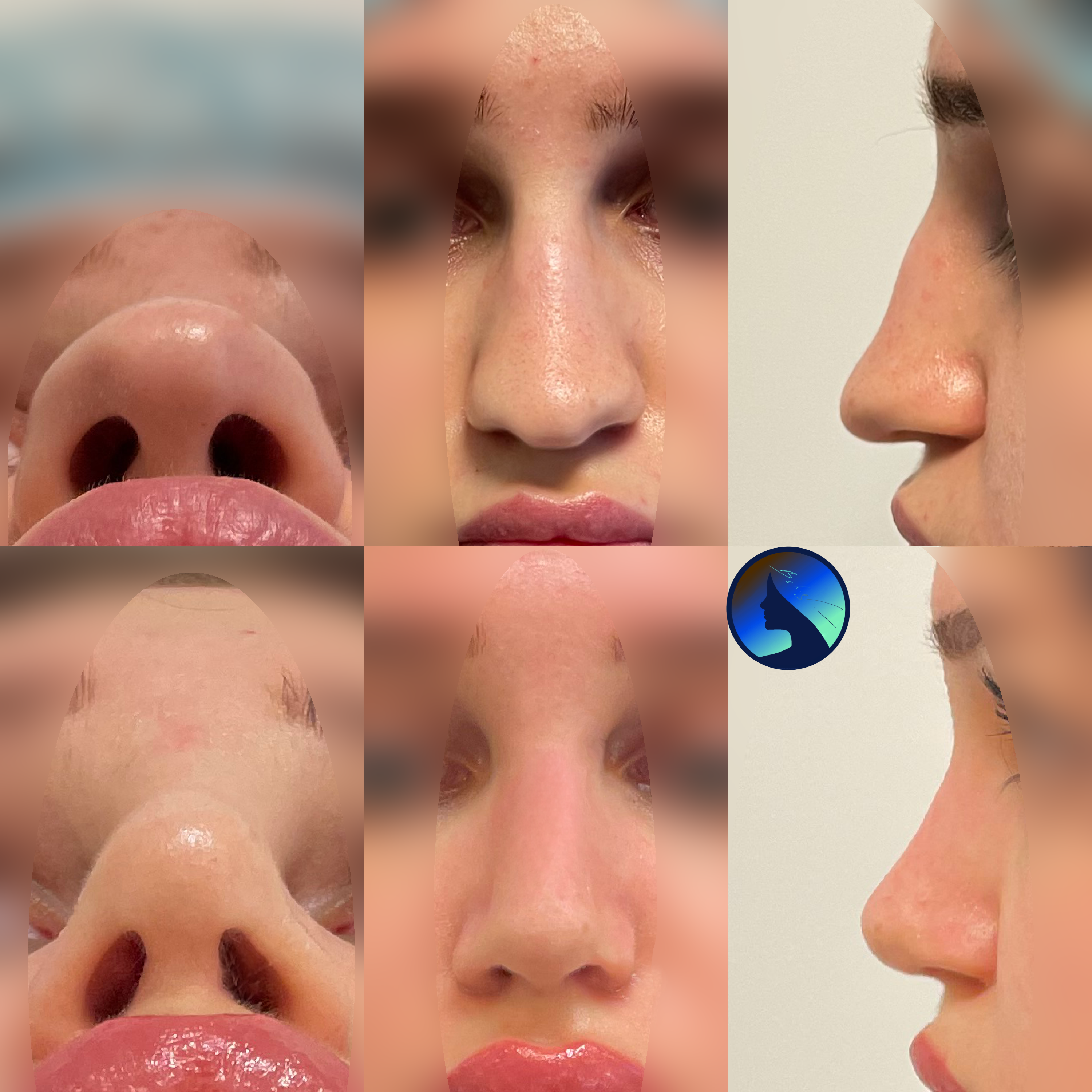 calkowita korekta nosa