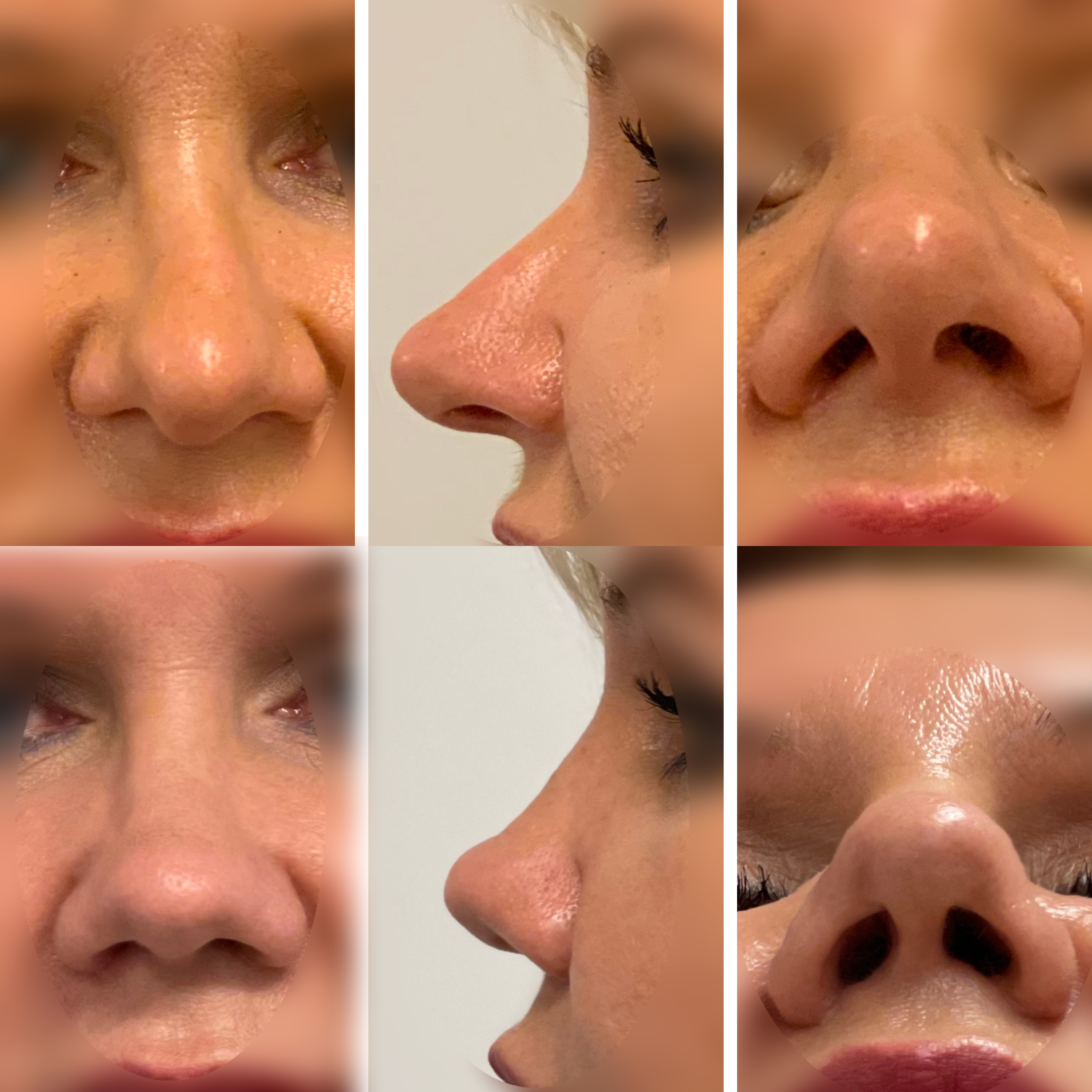 Wtórna korekta nosa