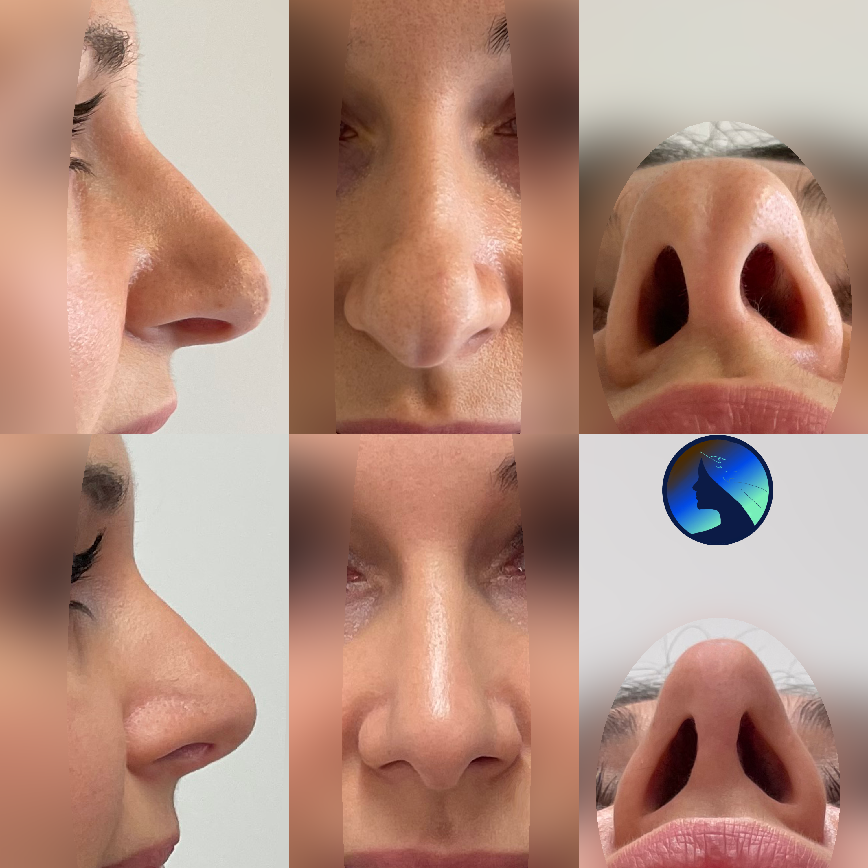 Wtórna korekta nosa