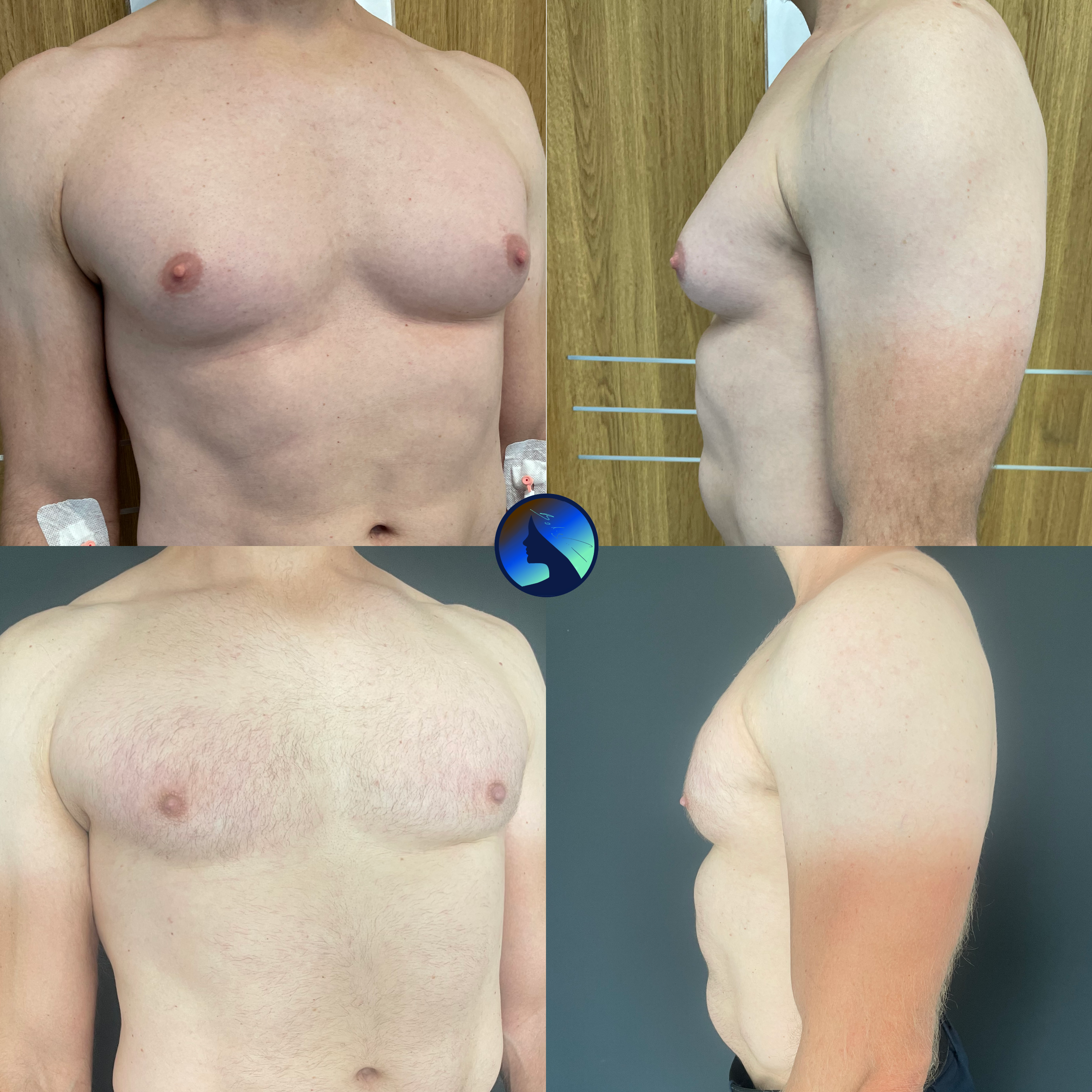 muscular ginecomastia