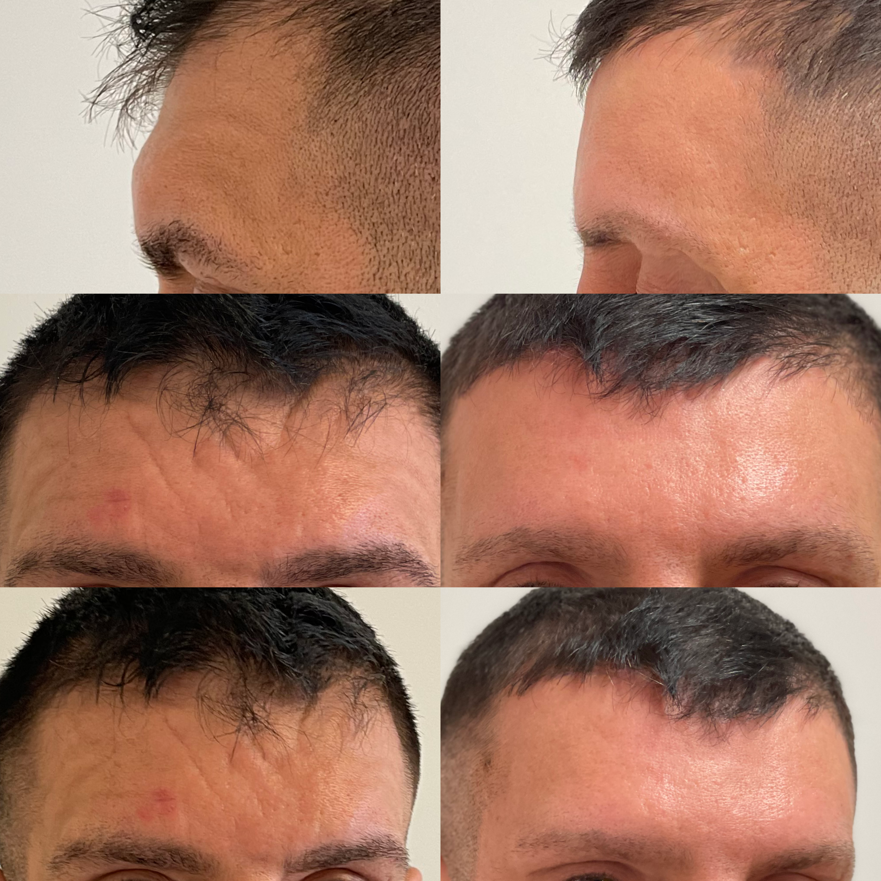 piłowanie guzów czołowych