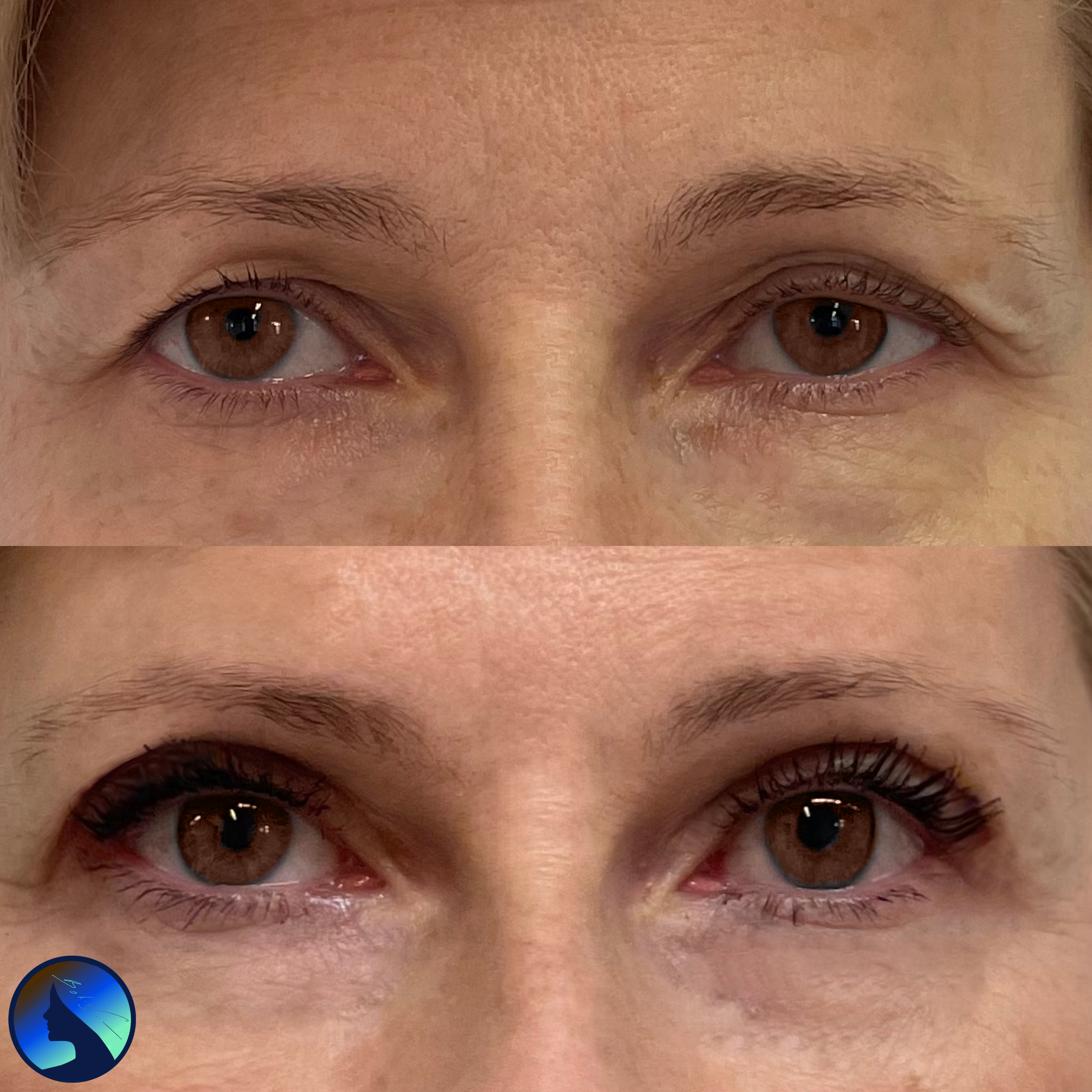 upper blepharoplasty