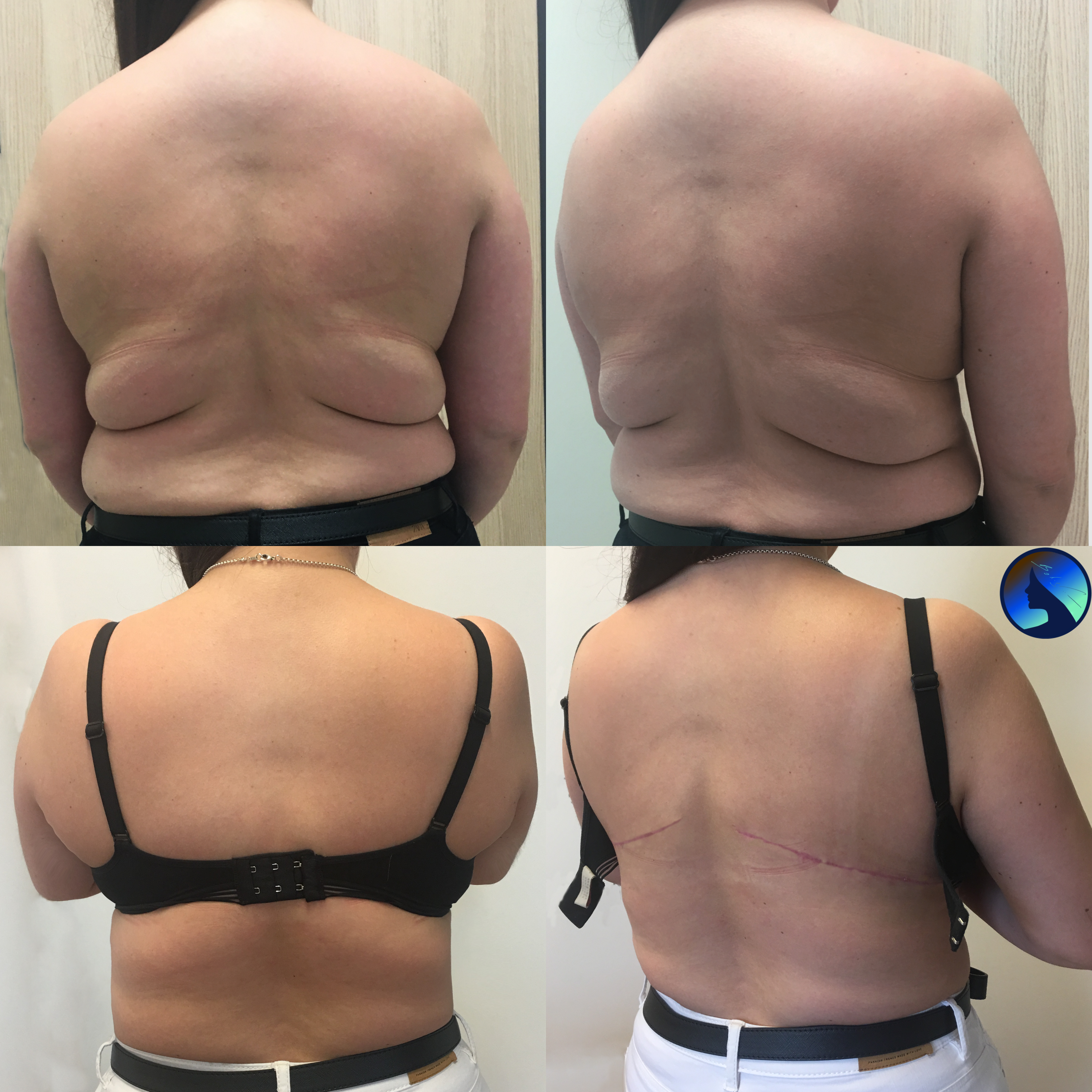 wdowi kark i plastyka plecow