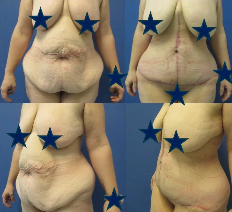 Revision Transaxillary