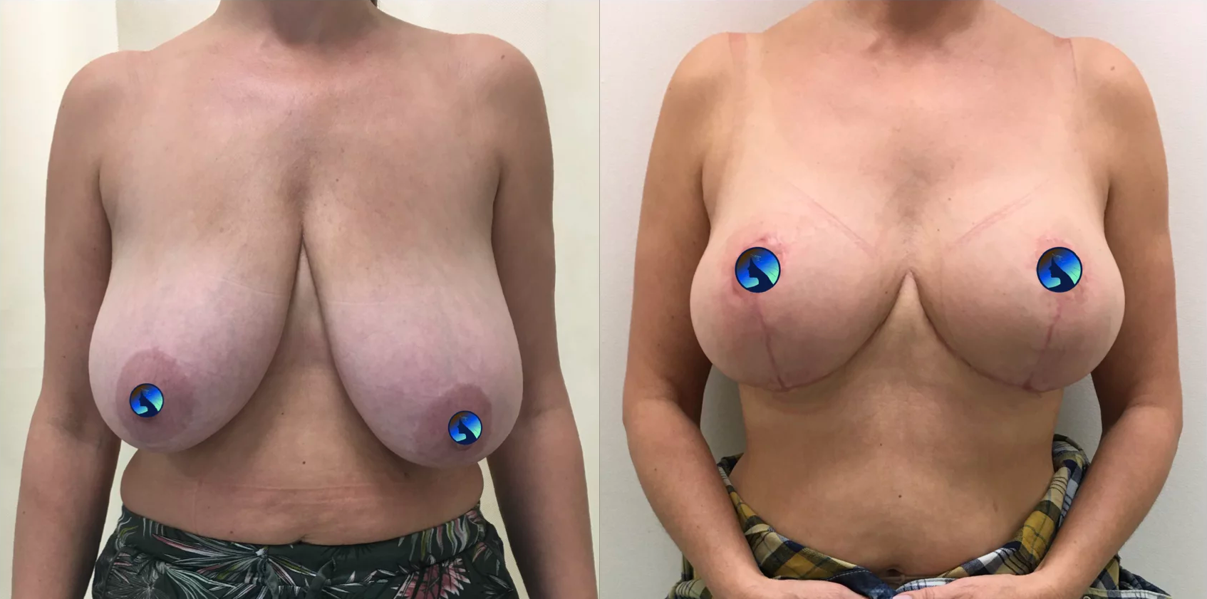 endoscopic tuberous breast augmentation