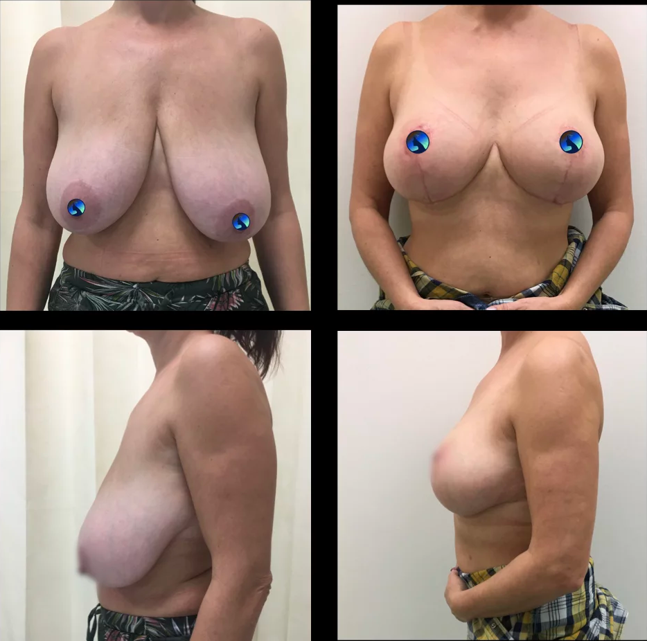 endoscopic tuberous breast augmentation