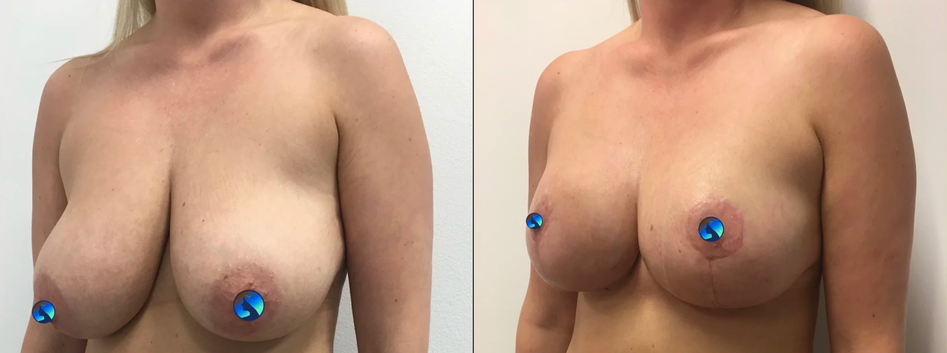 Endoskopowa augmentacja piersi