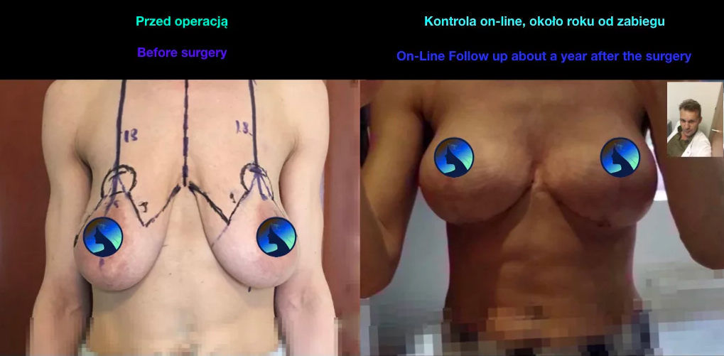 Endoskopowa augmentacja piersi