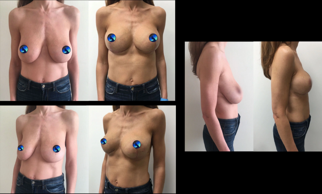 Endoskopowa augmentacja piersi