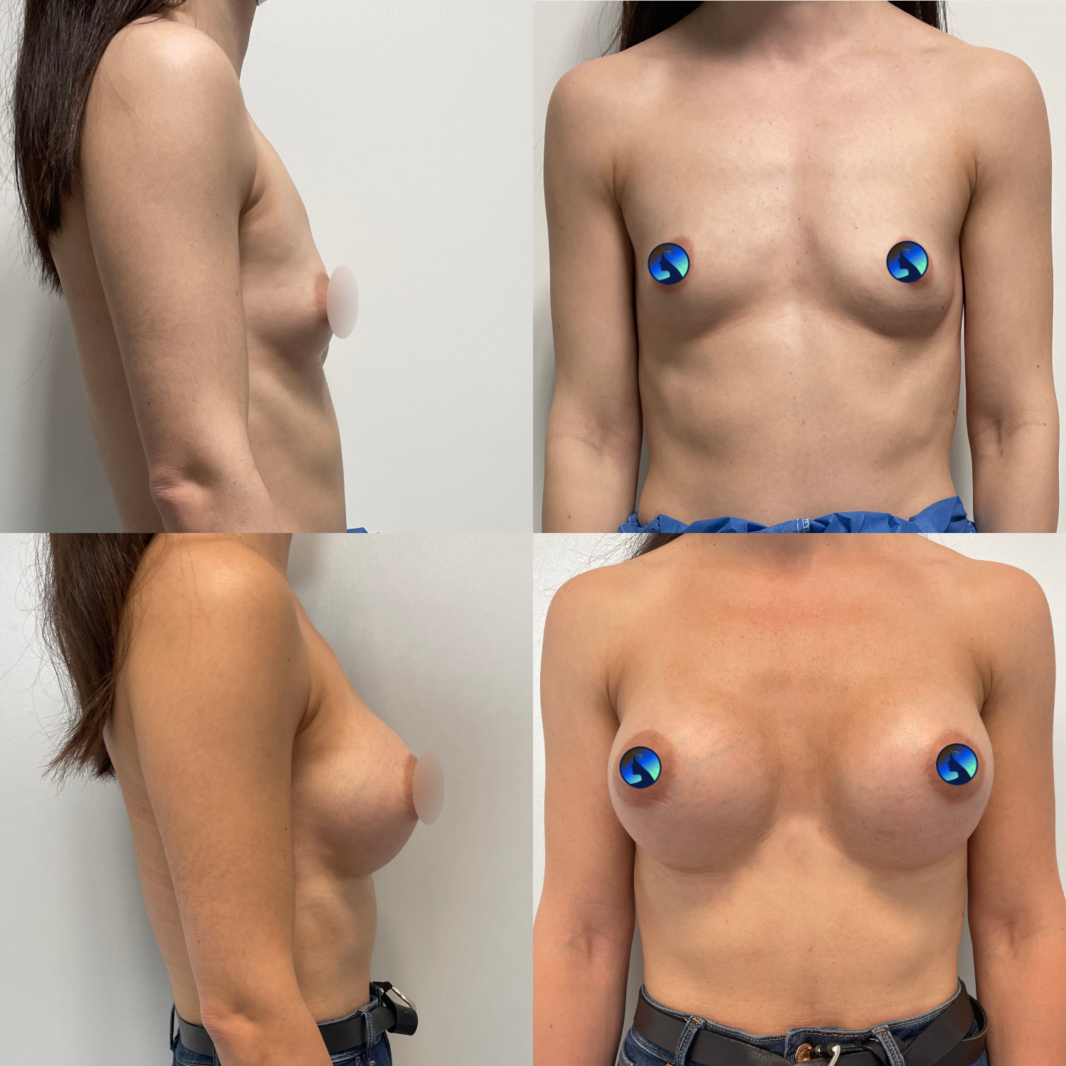 Beautiful Transaxillary Breast Augmentation