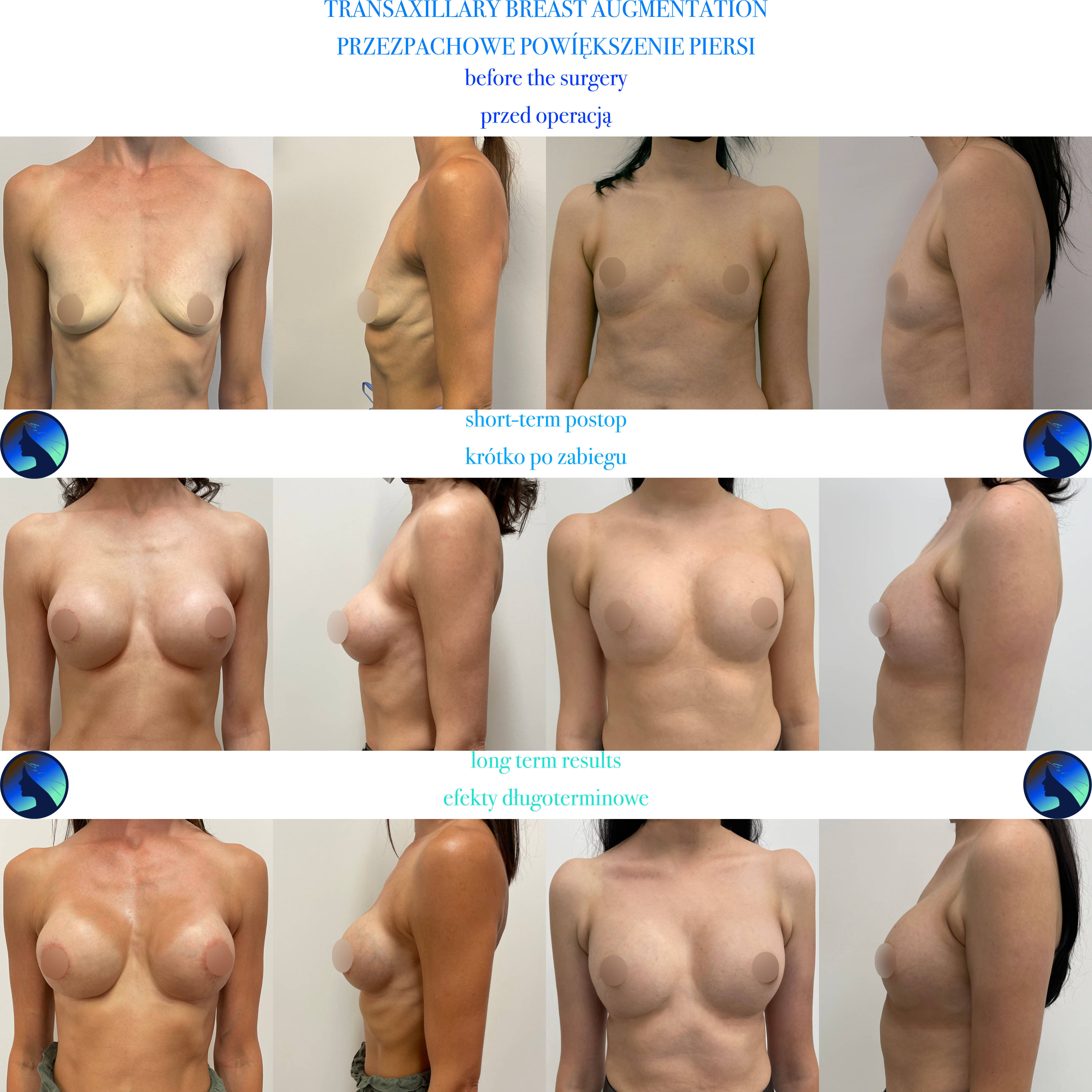 Breast Augmentation Long term results