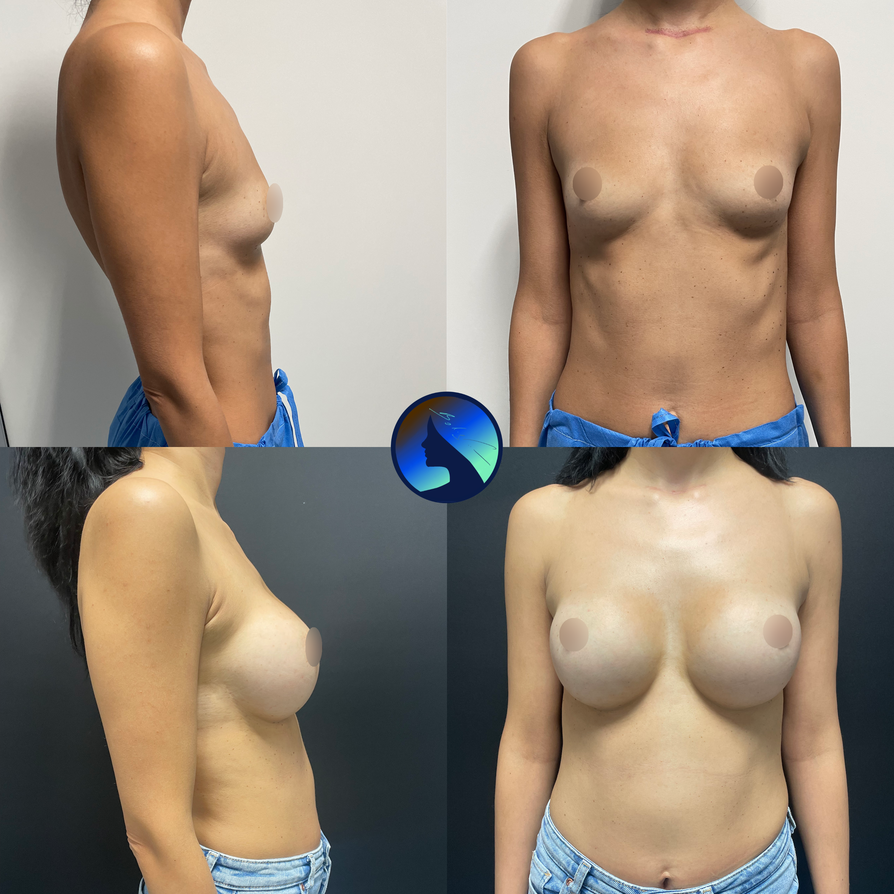 Breast reconstruction after 3 pregnancies