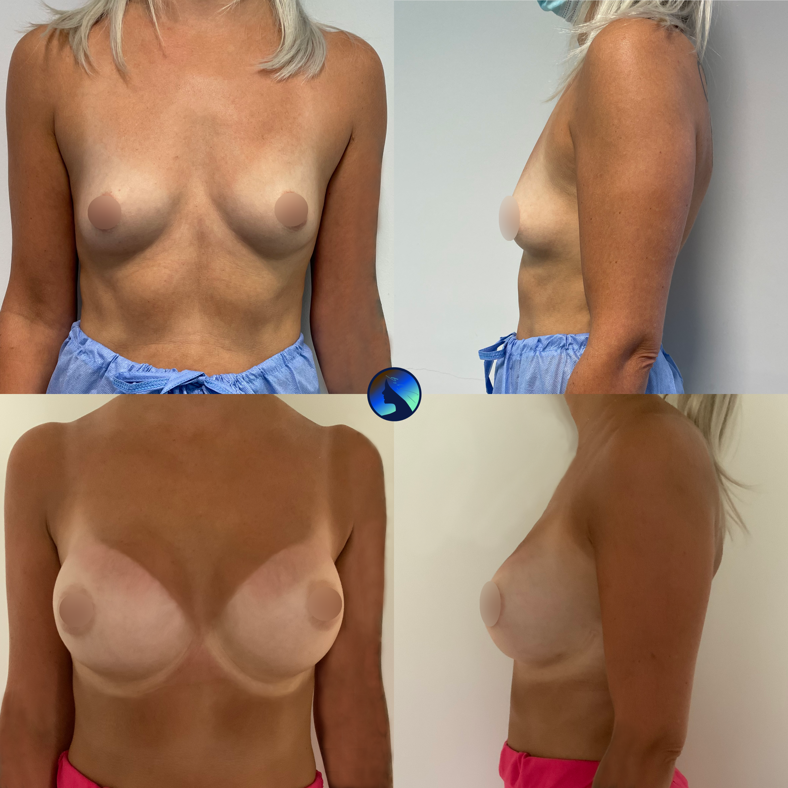 Breasts and wired Bra