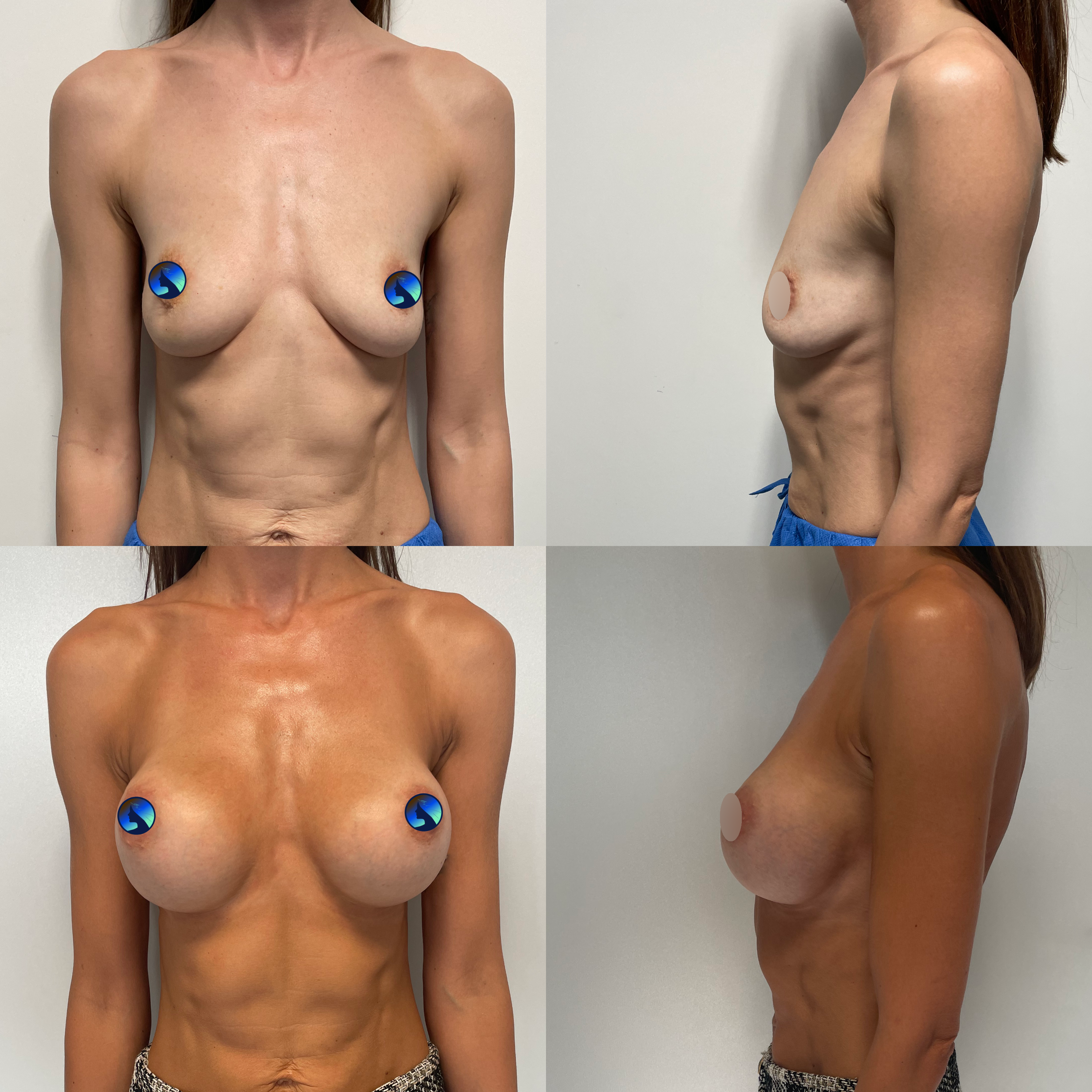 Breasts implants on a model