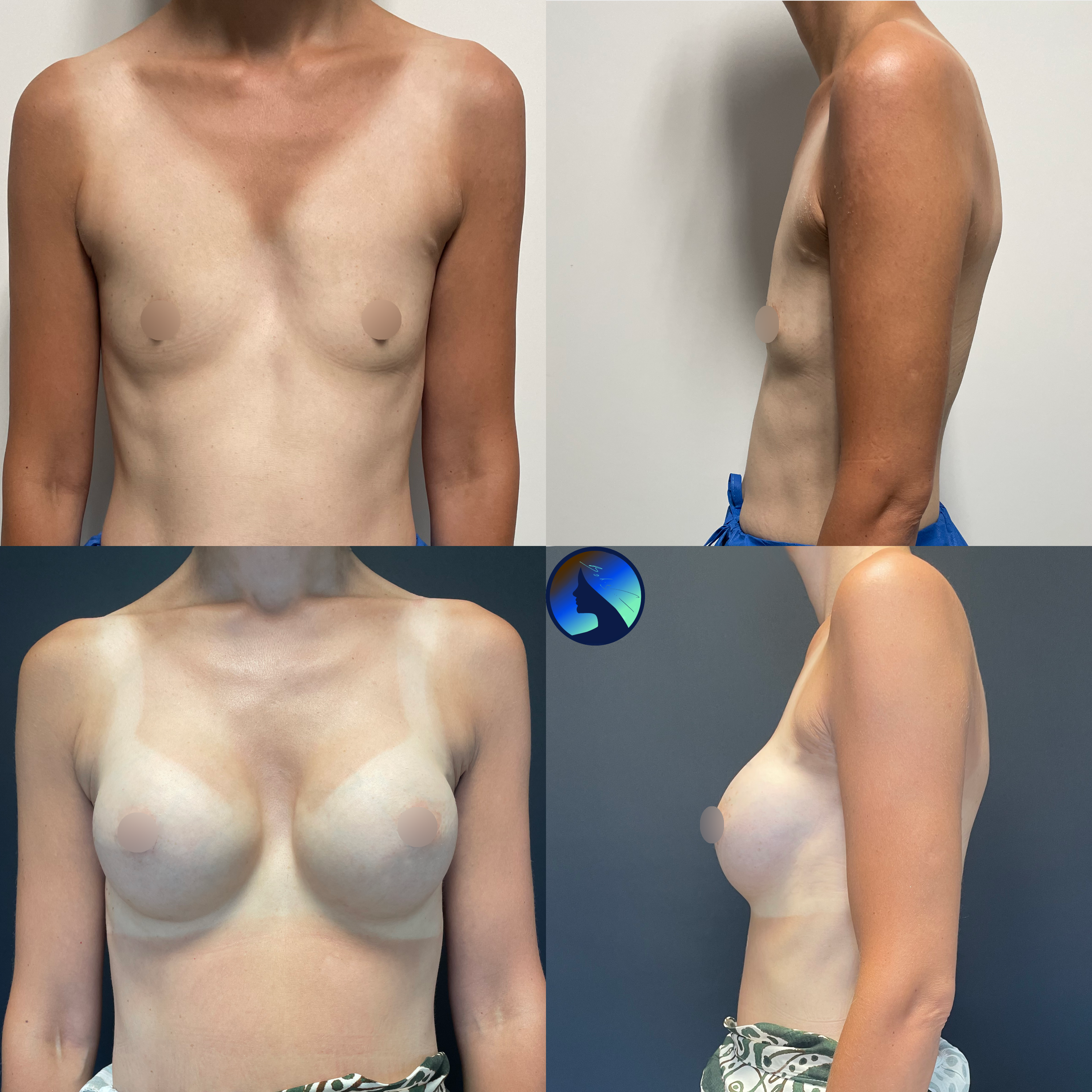 Breasts symmetrization endoscopy