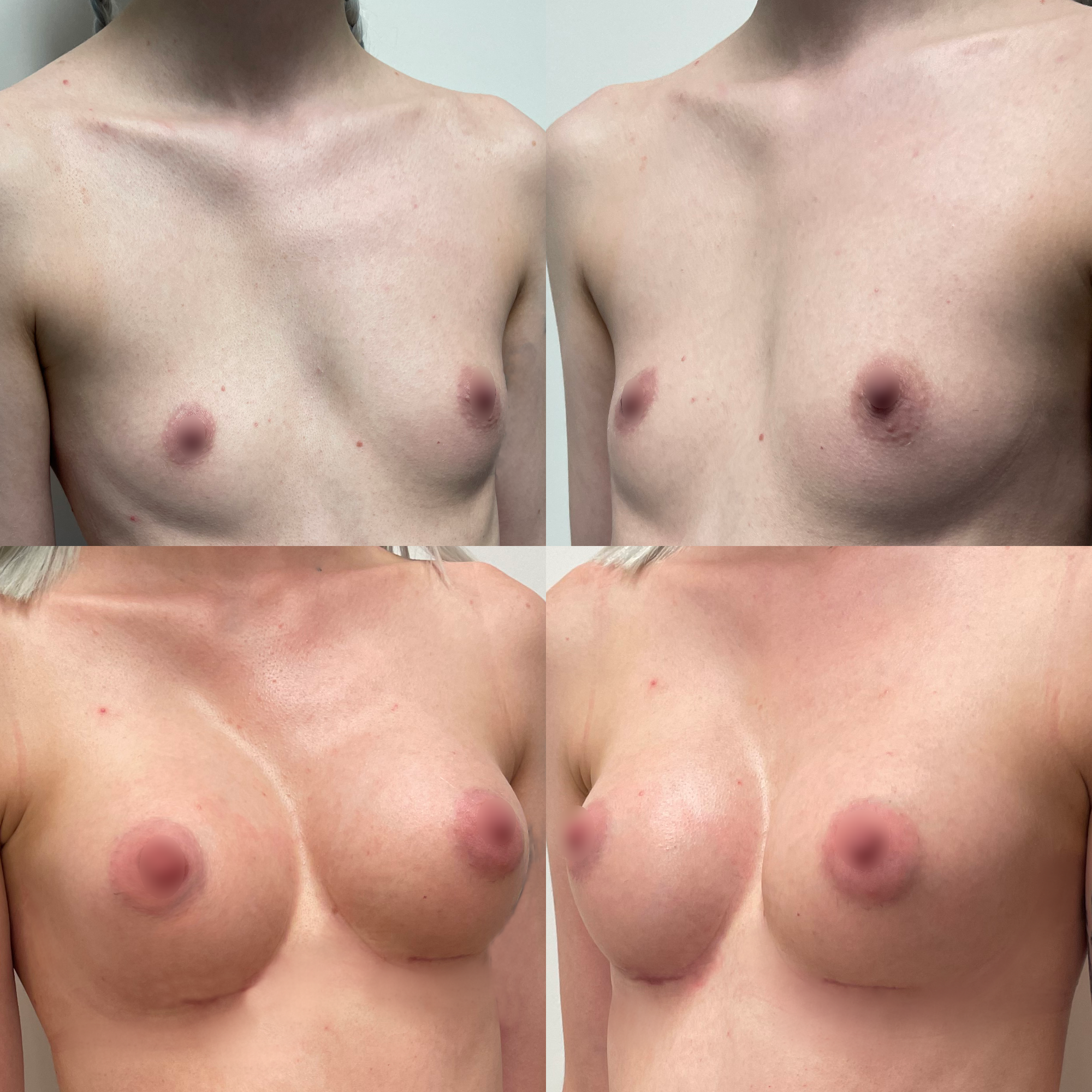 Chest Asymmetry Poliurethane