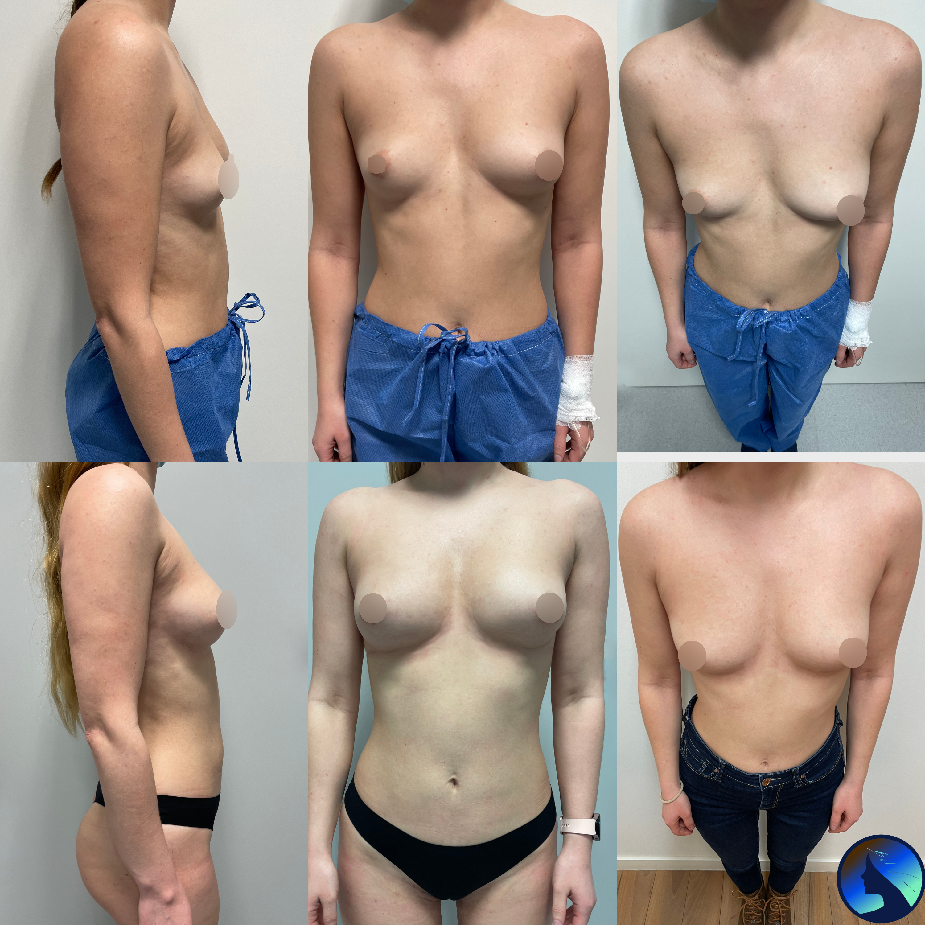 Chest symmetrization