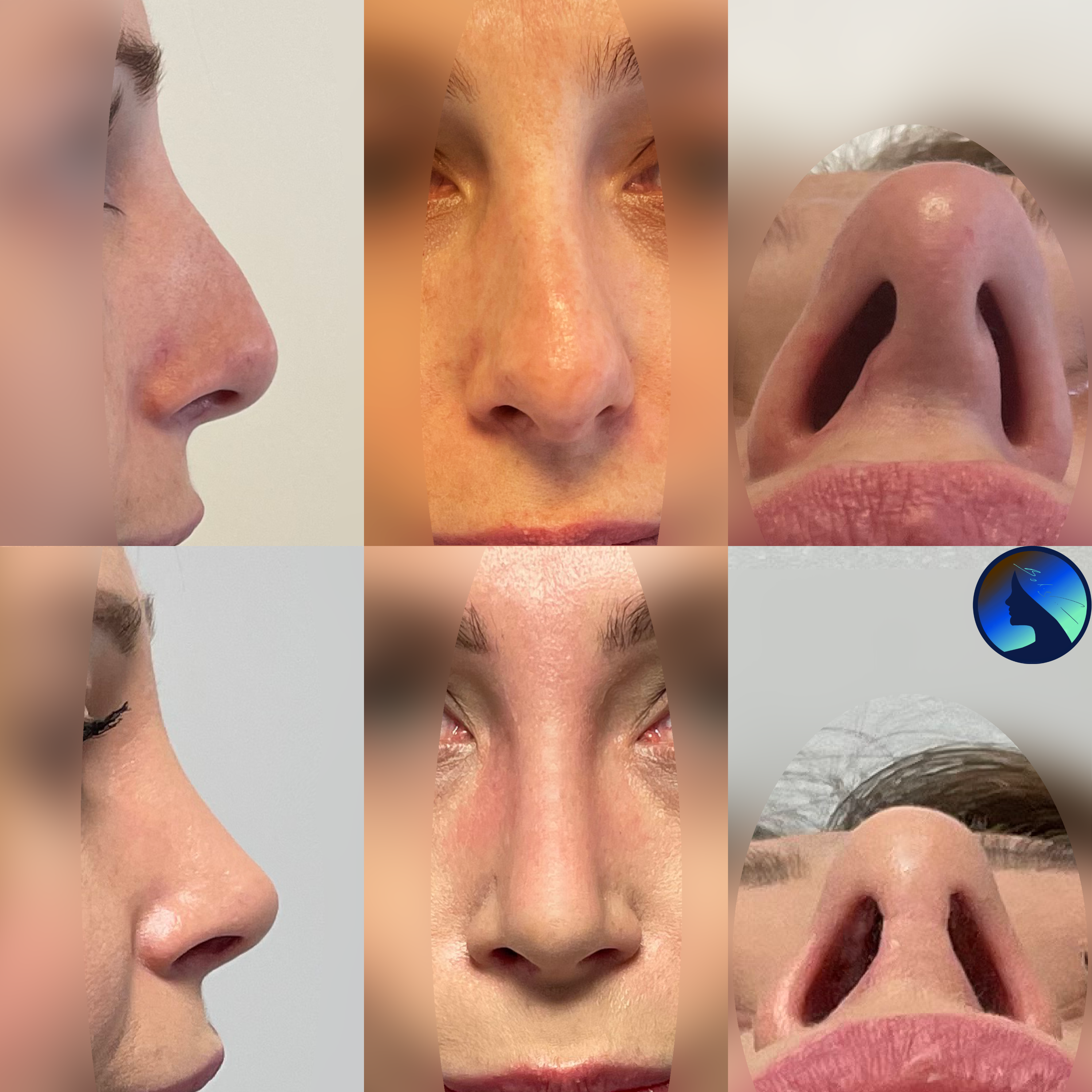 Difficult-secondary-rhinoplasty