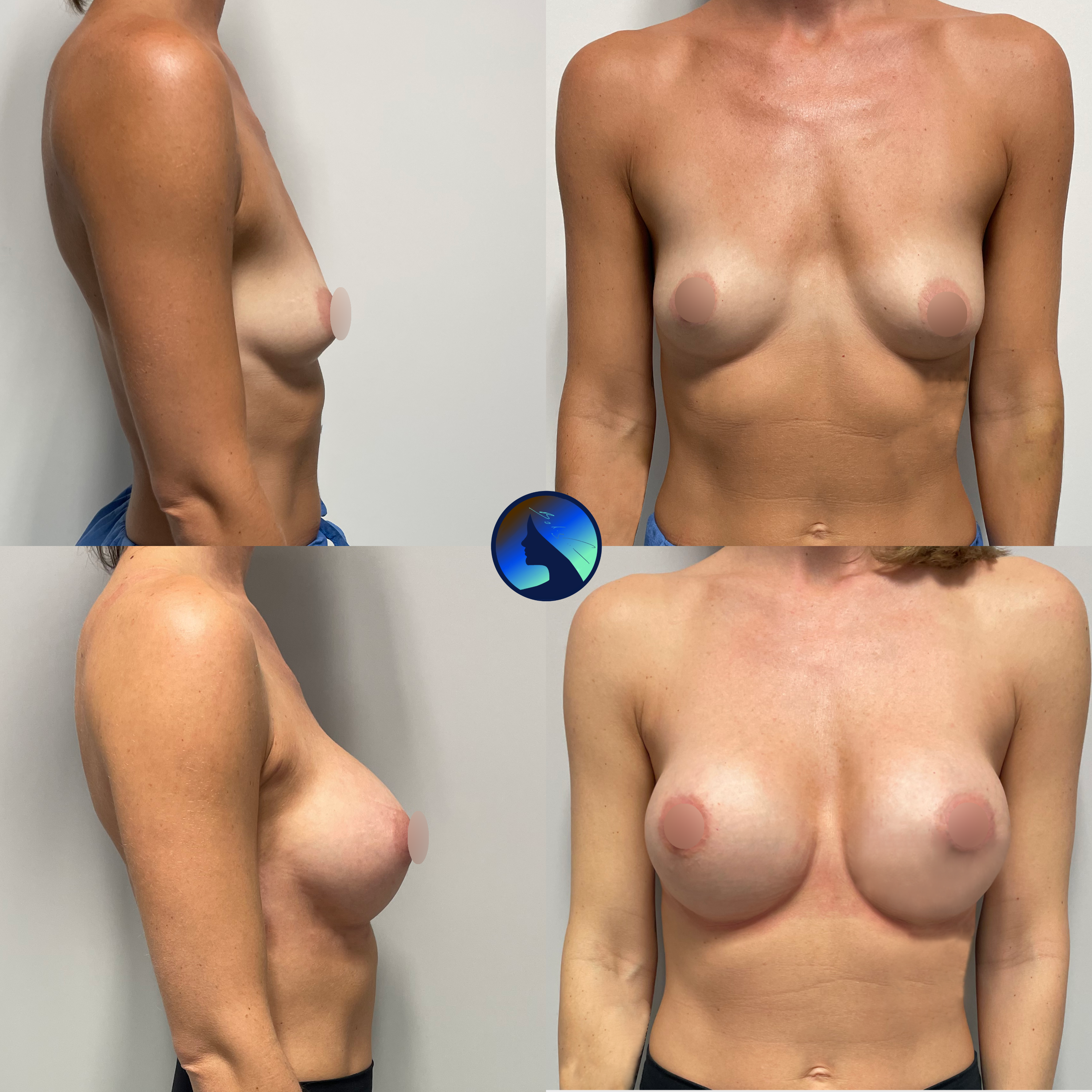 Endoskopowe powiększenie piersi