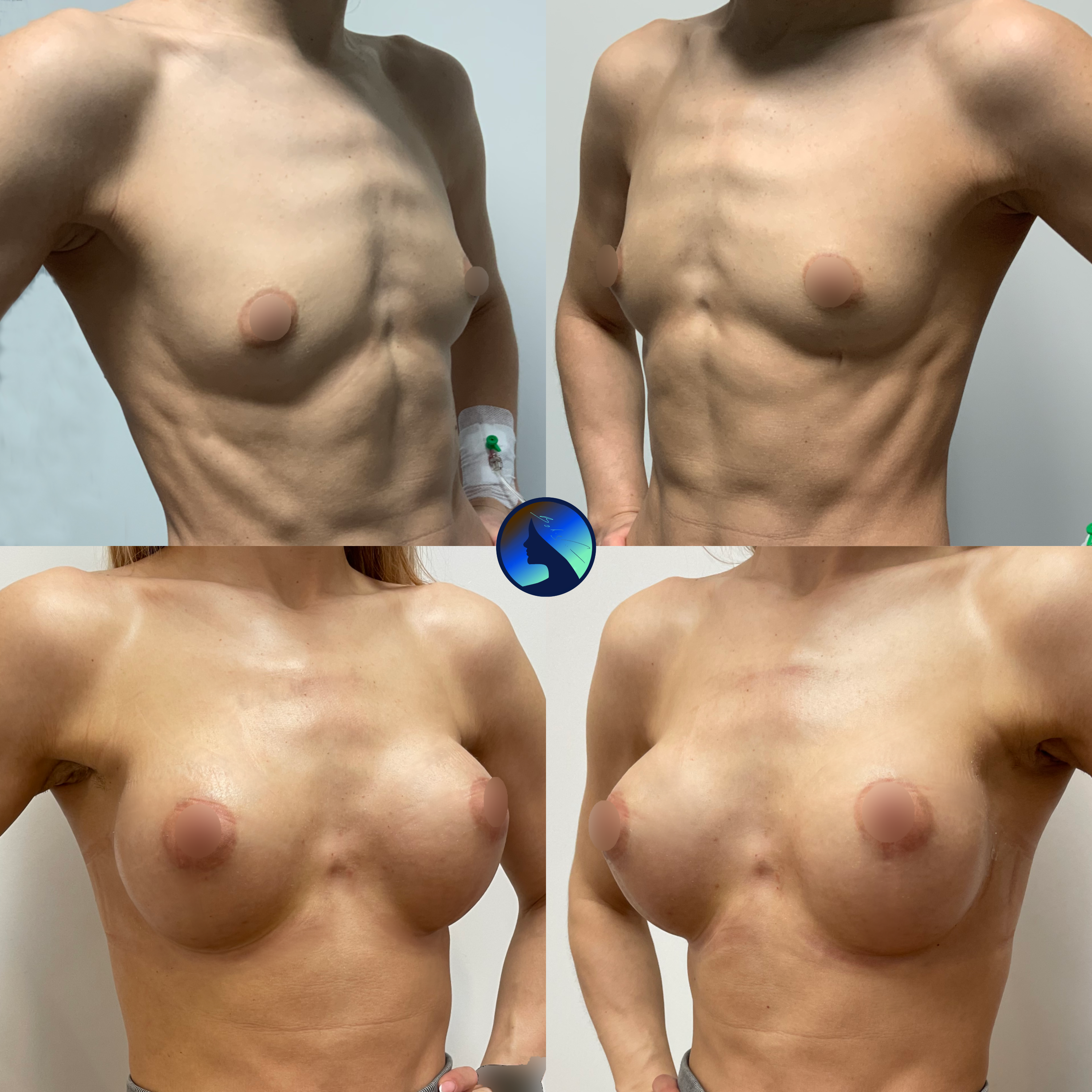 Endoscopic breast Augmentation 2