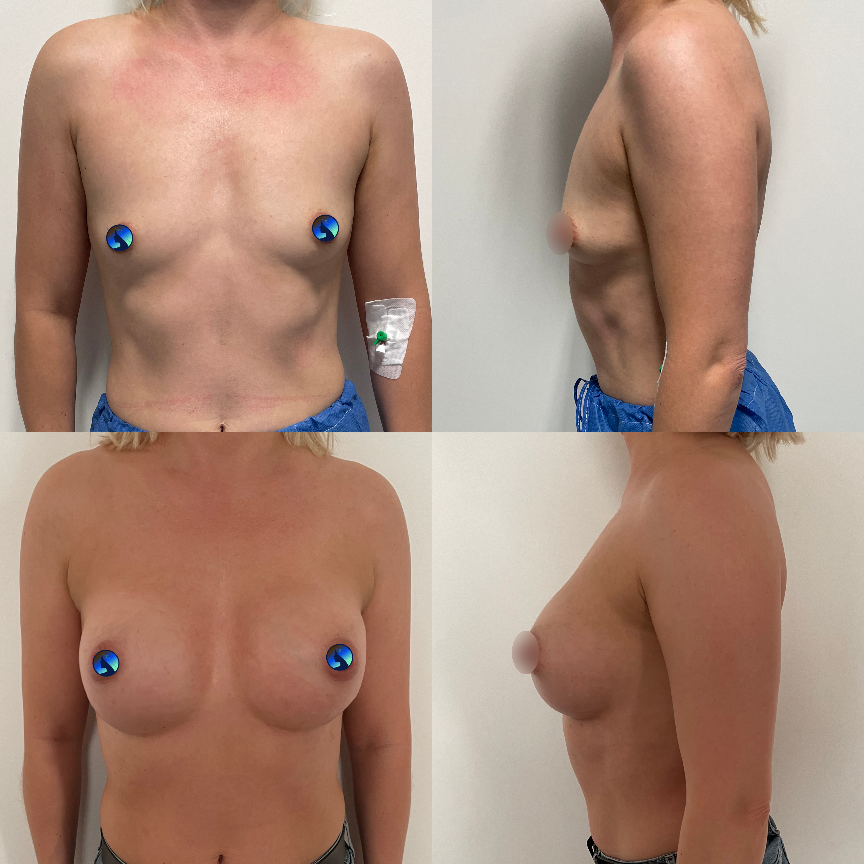 Endoskopowa augmentacja piersi