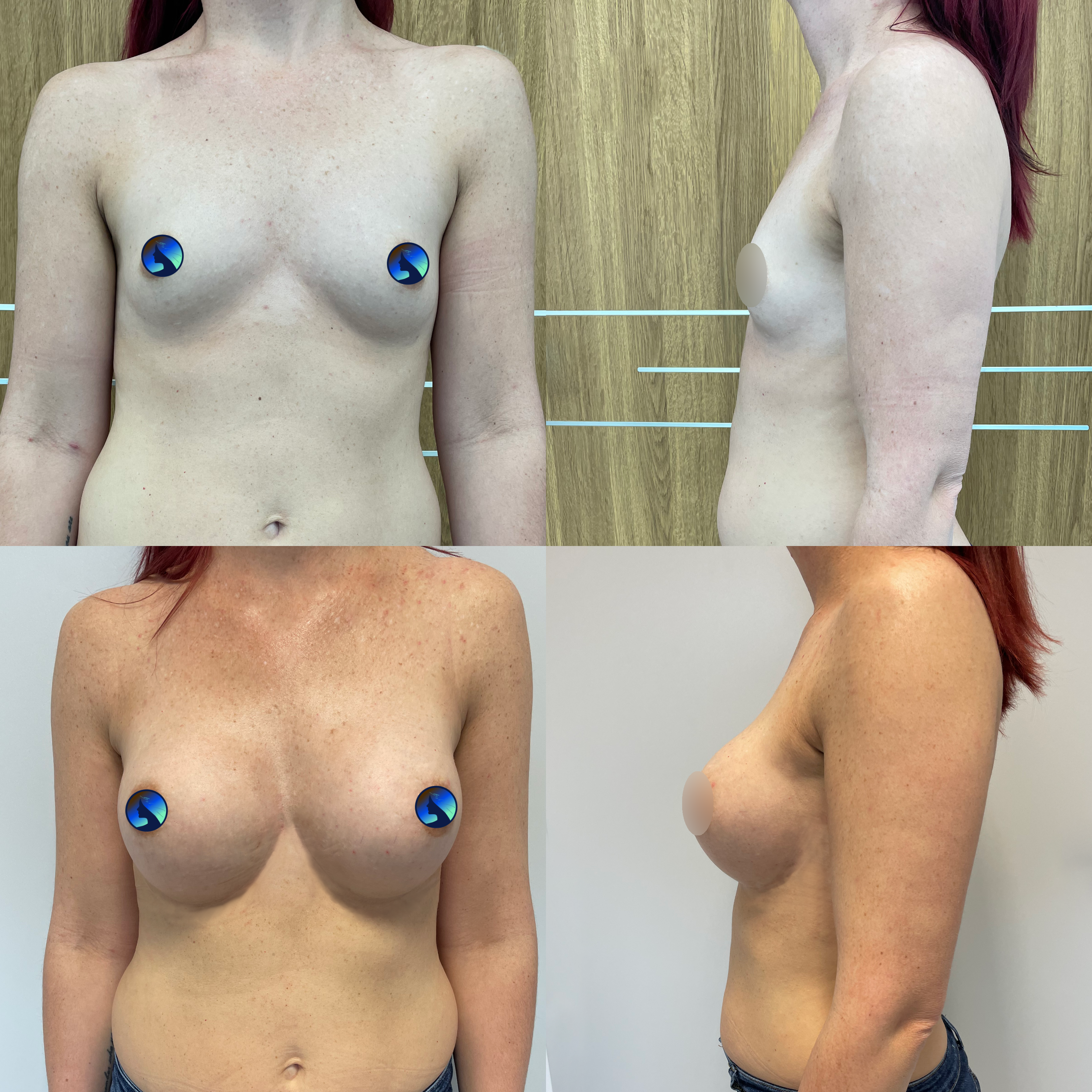 Endoskopowa korekcja asymetrycznych piersi