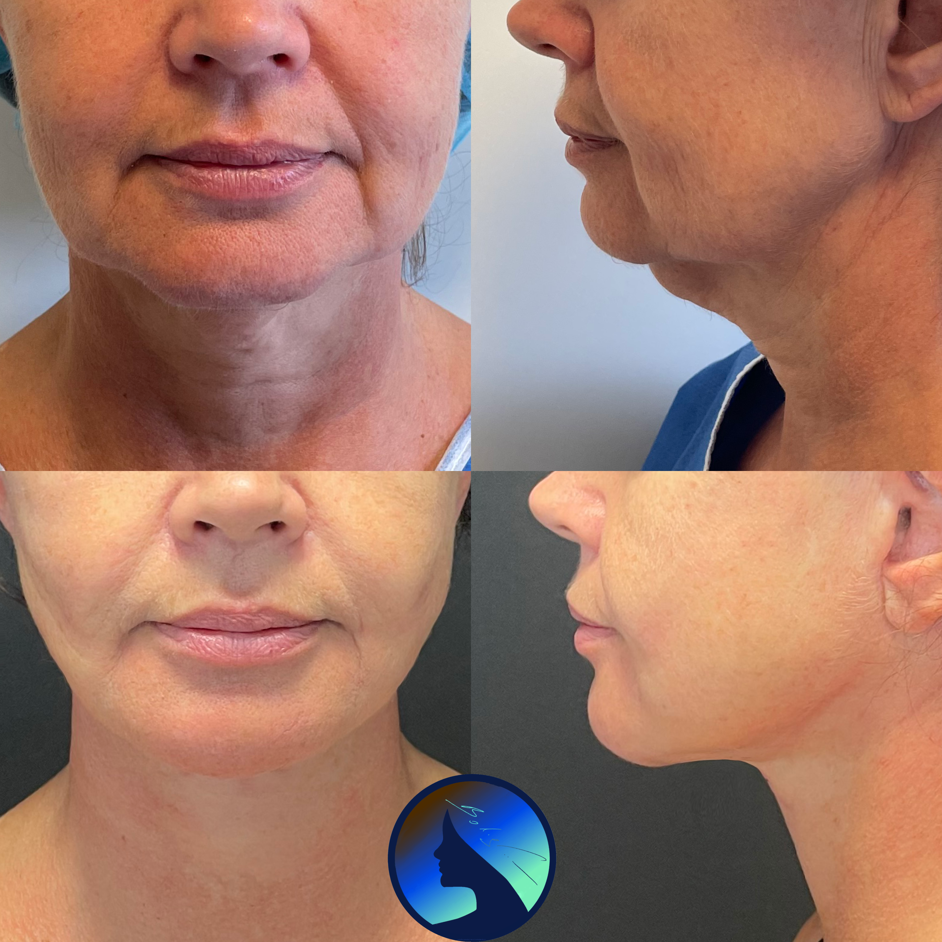 Full Face- and Necklift