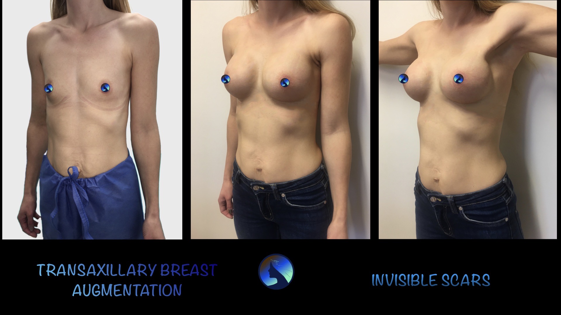 Endoskopowe powiększenie piersi