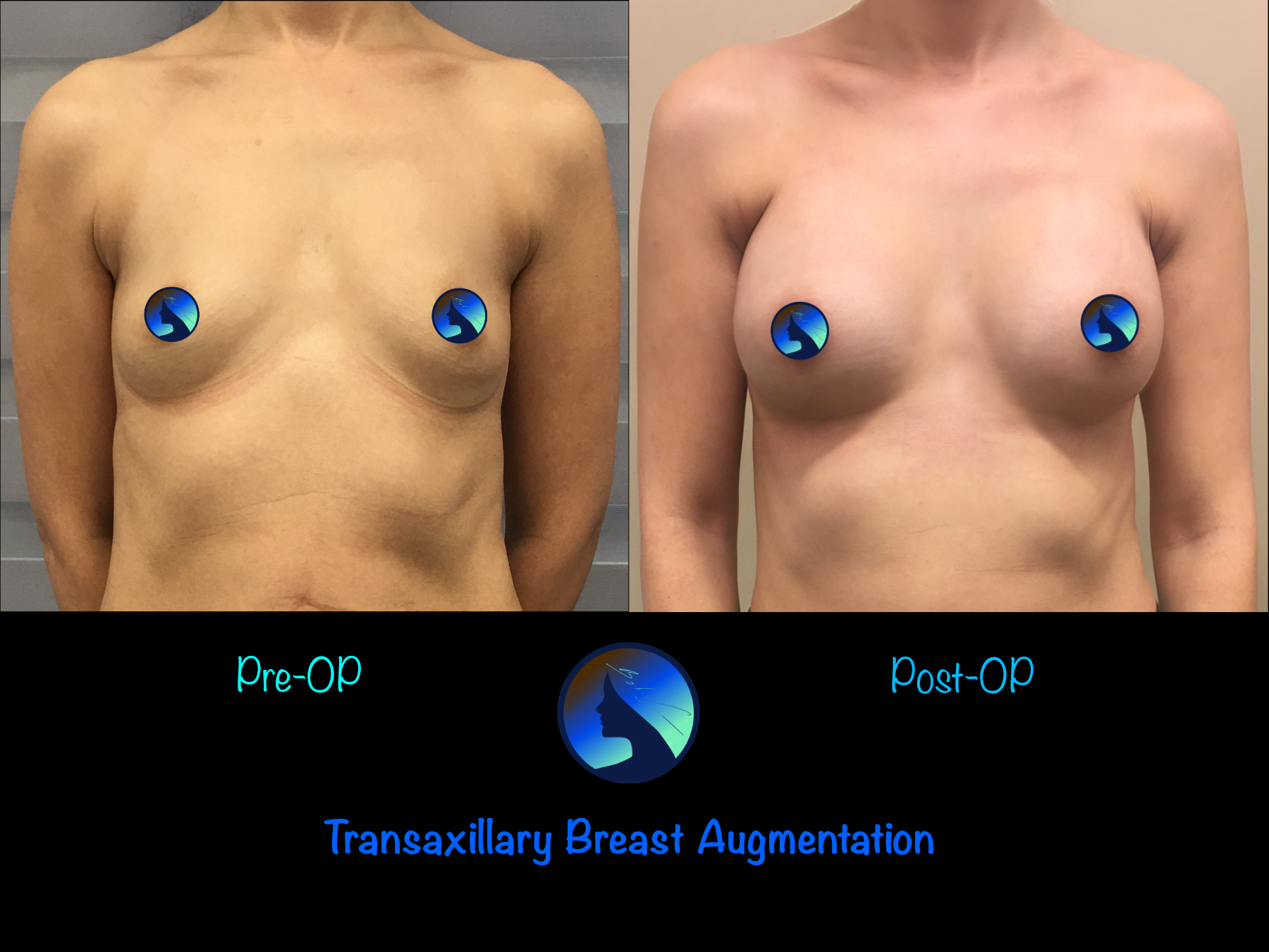 Endoskopowe powiększenie piersi