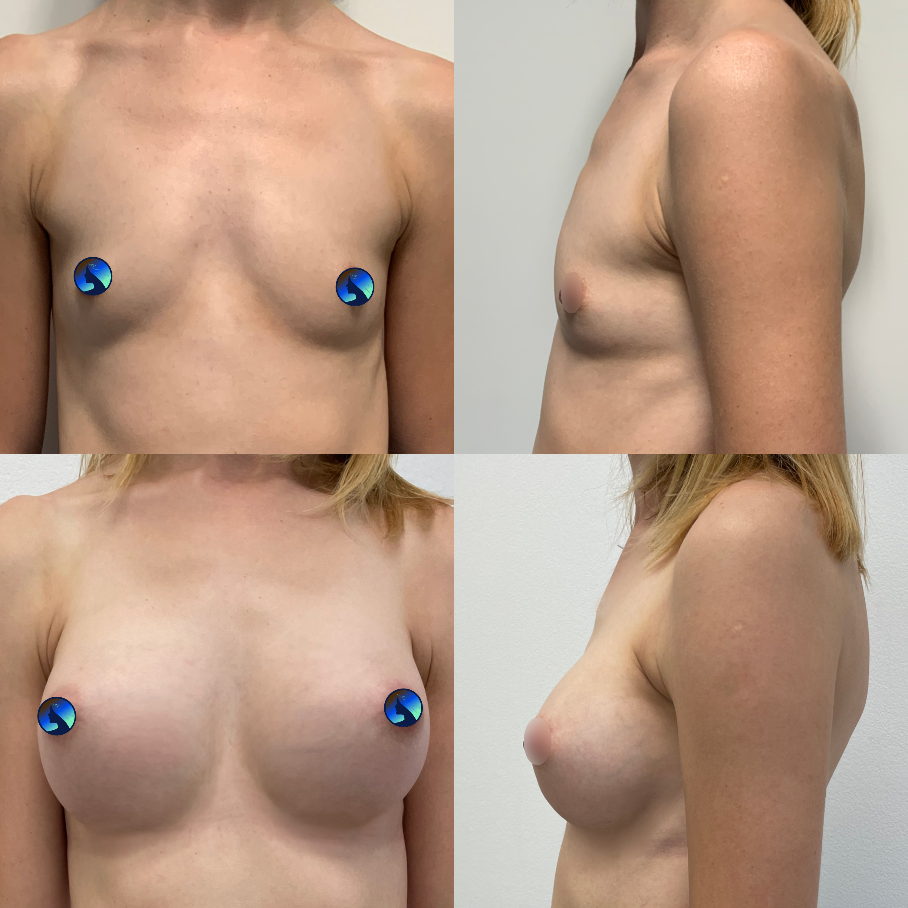 Przezpachowe powiększanie piersi