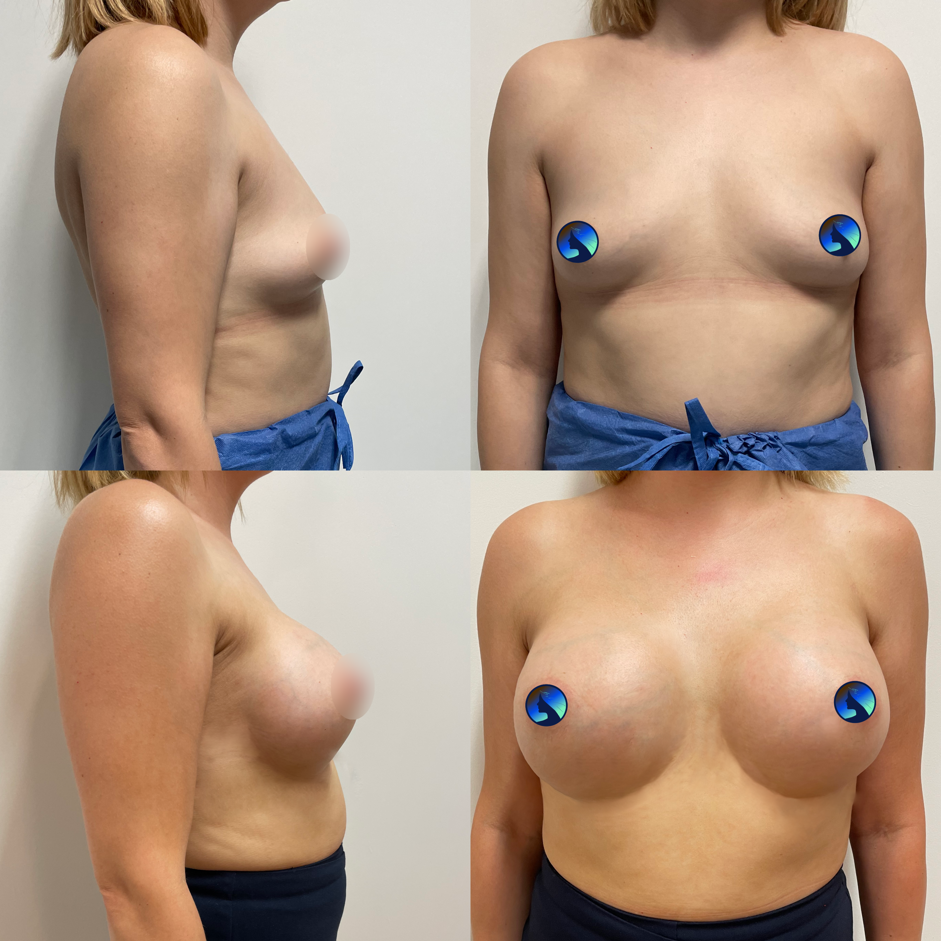 Pycnic breasts