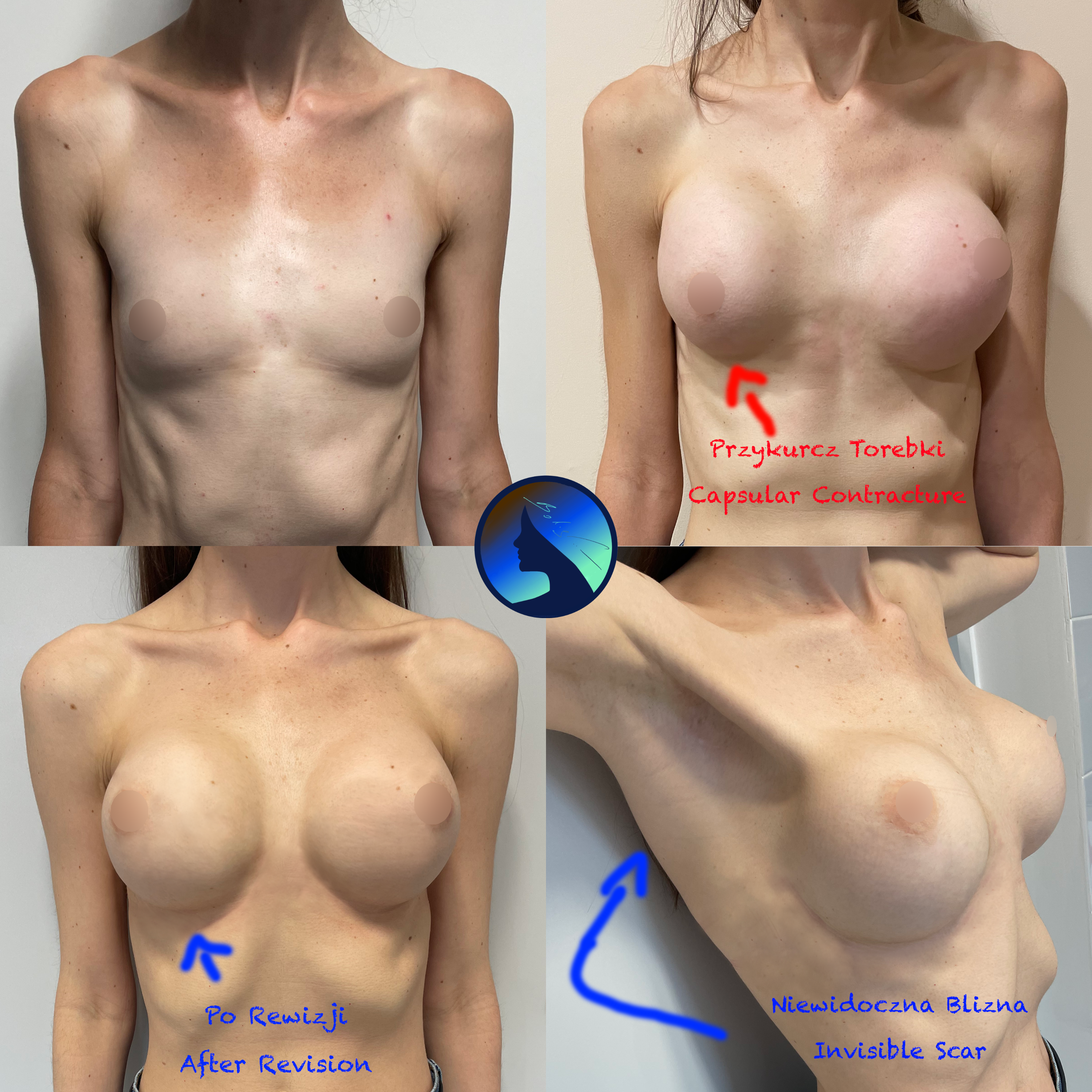 Revision Transaxillary