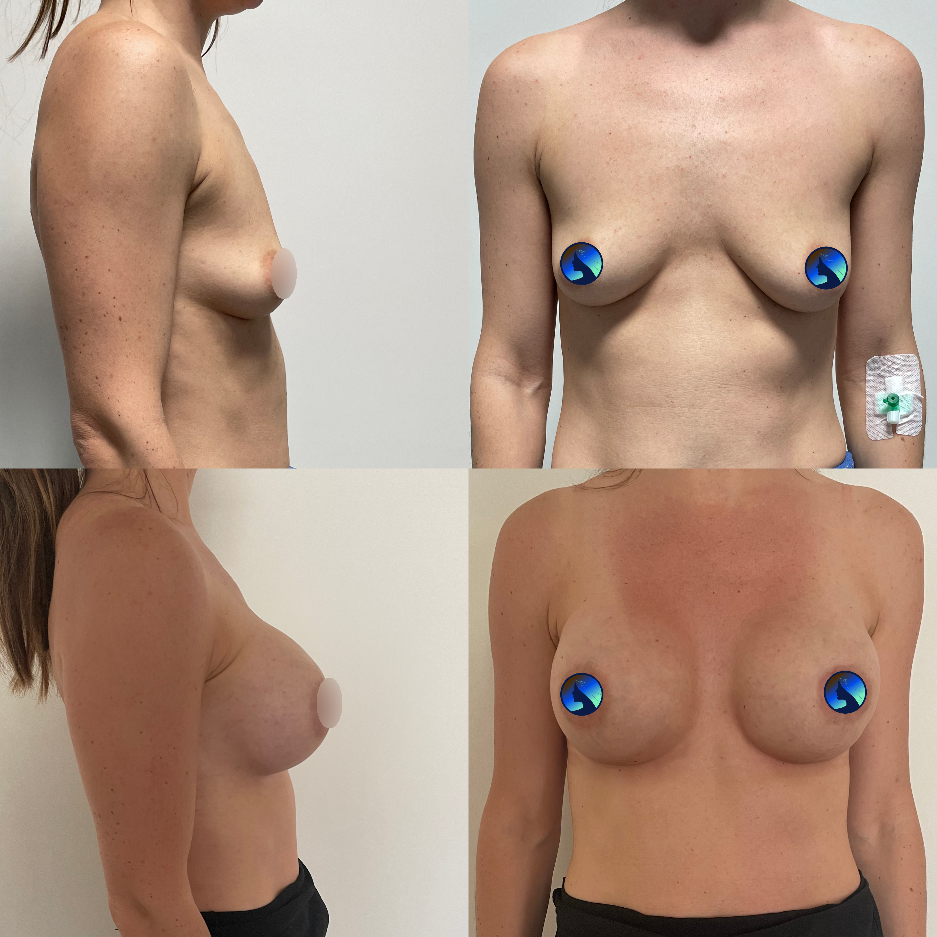 Scarless Breast Symmetrization