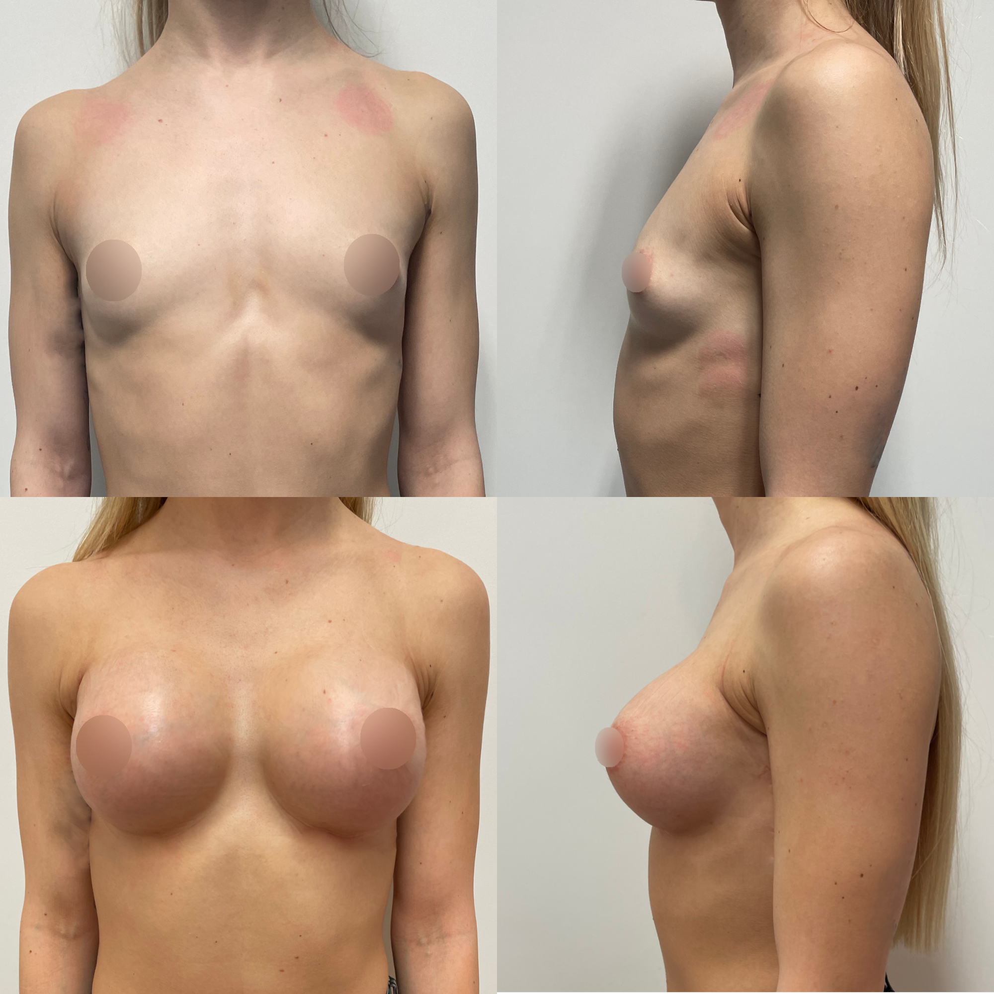 Transaxillary Landing