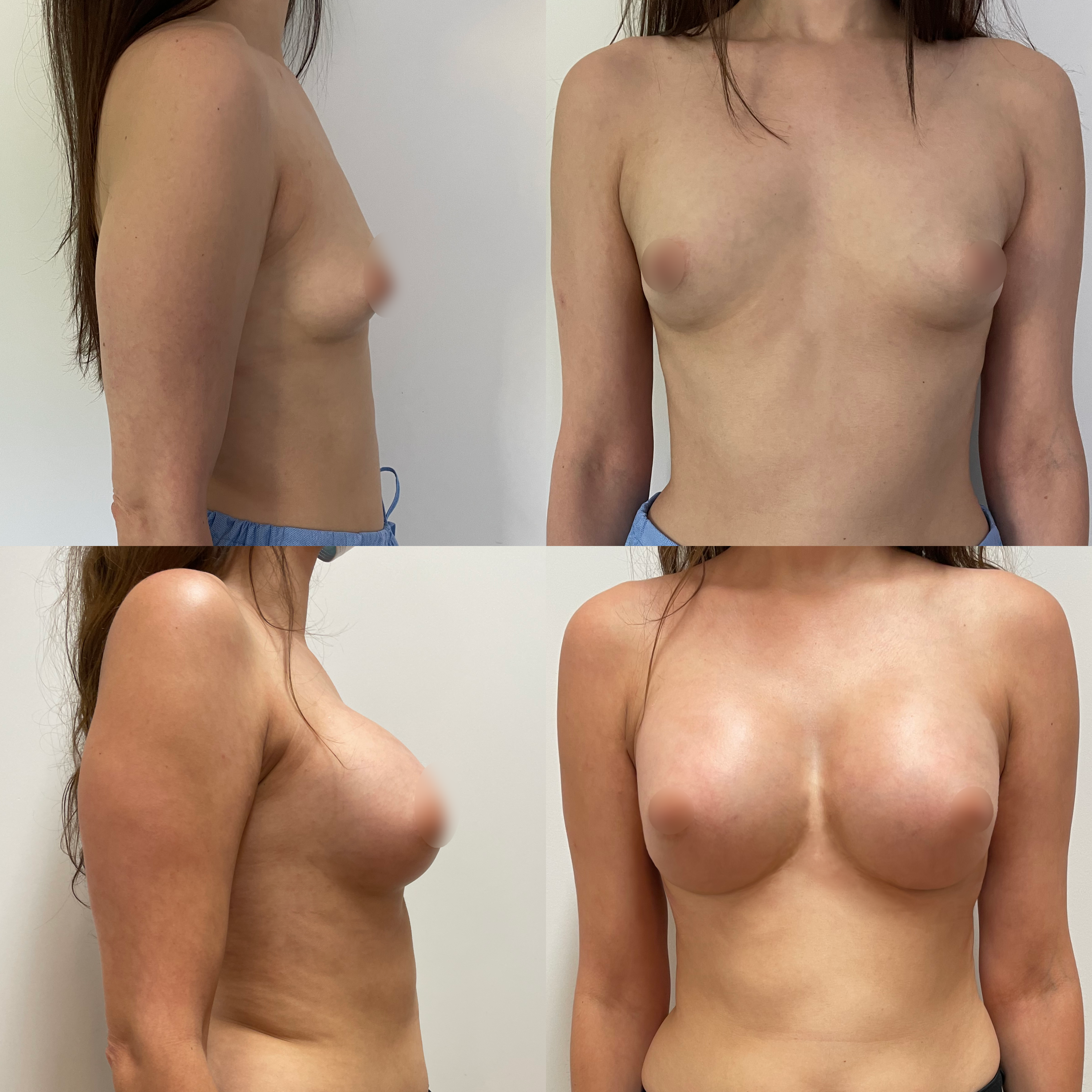 Transaxillary Landing