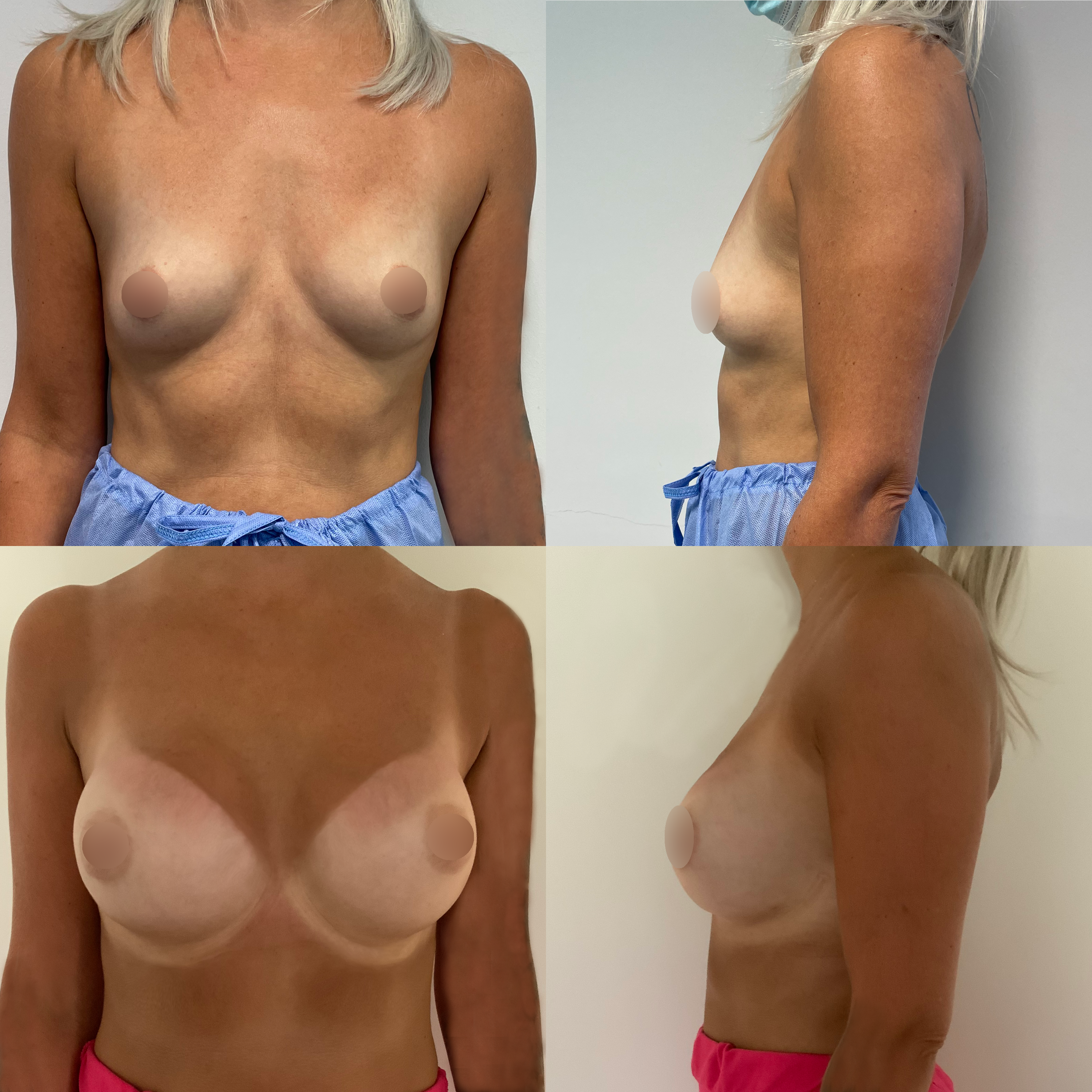 Transaxillary Landing