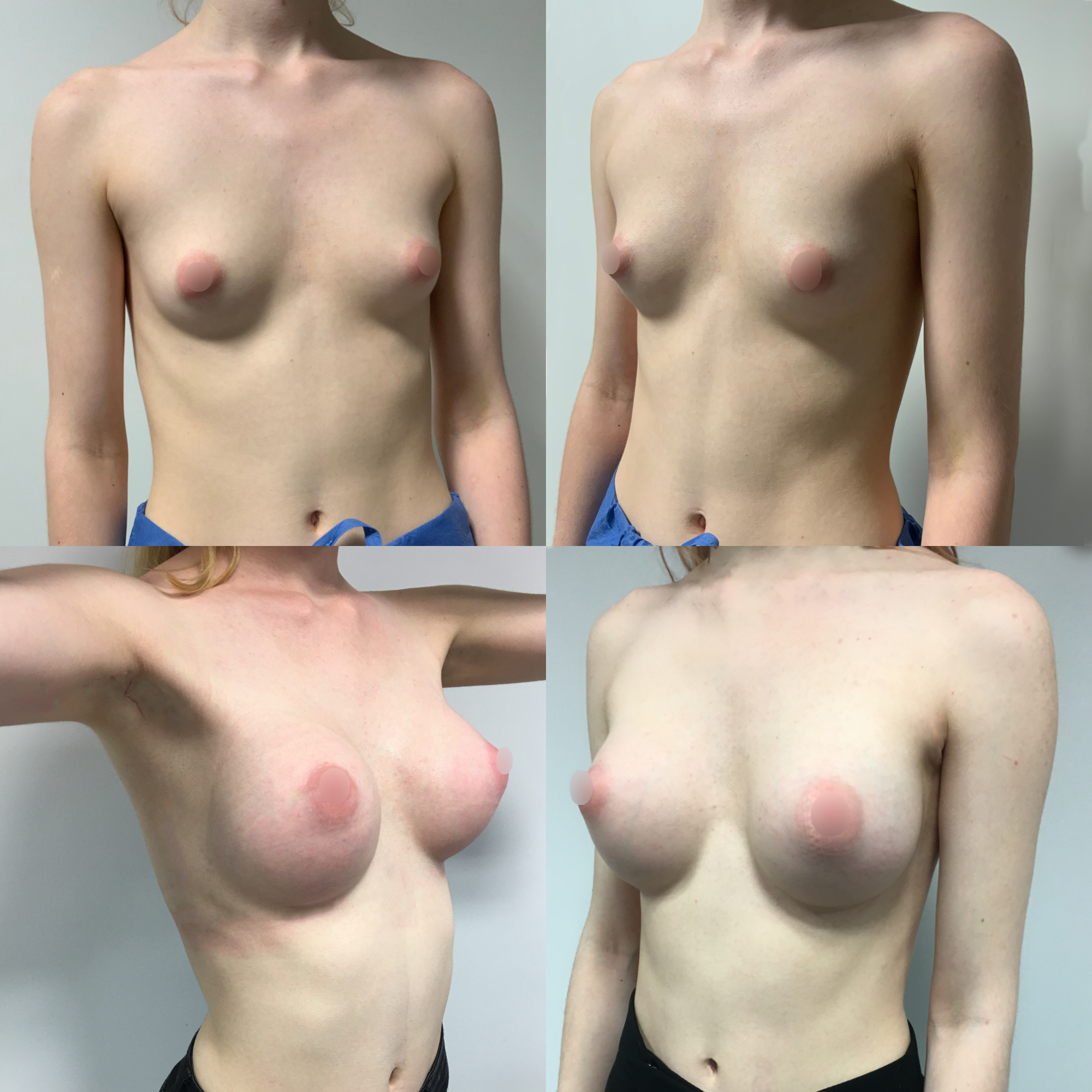 Transaxillary Landing