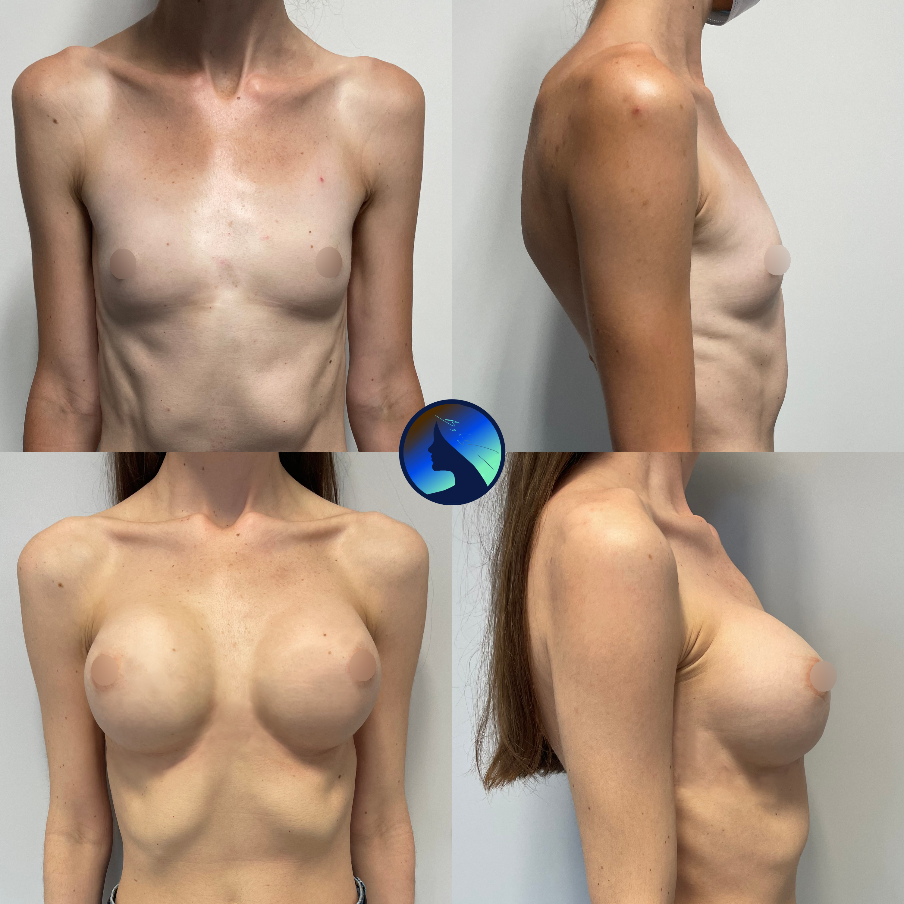 Transaxillary Thin Tall Patient