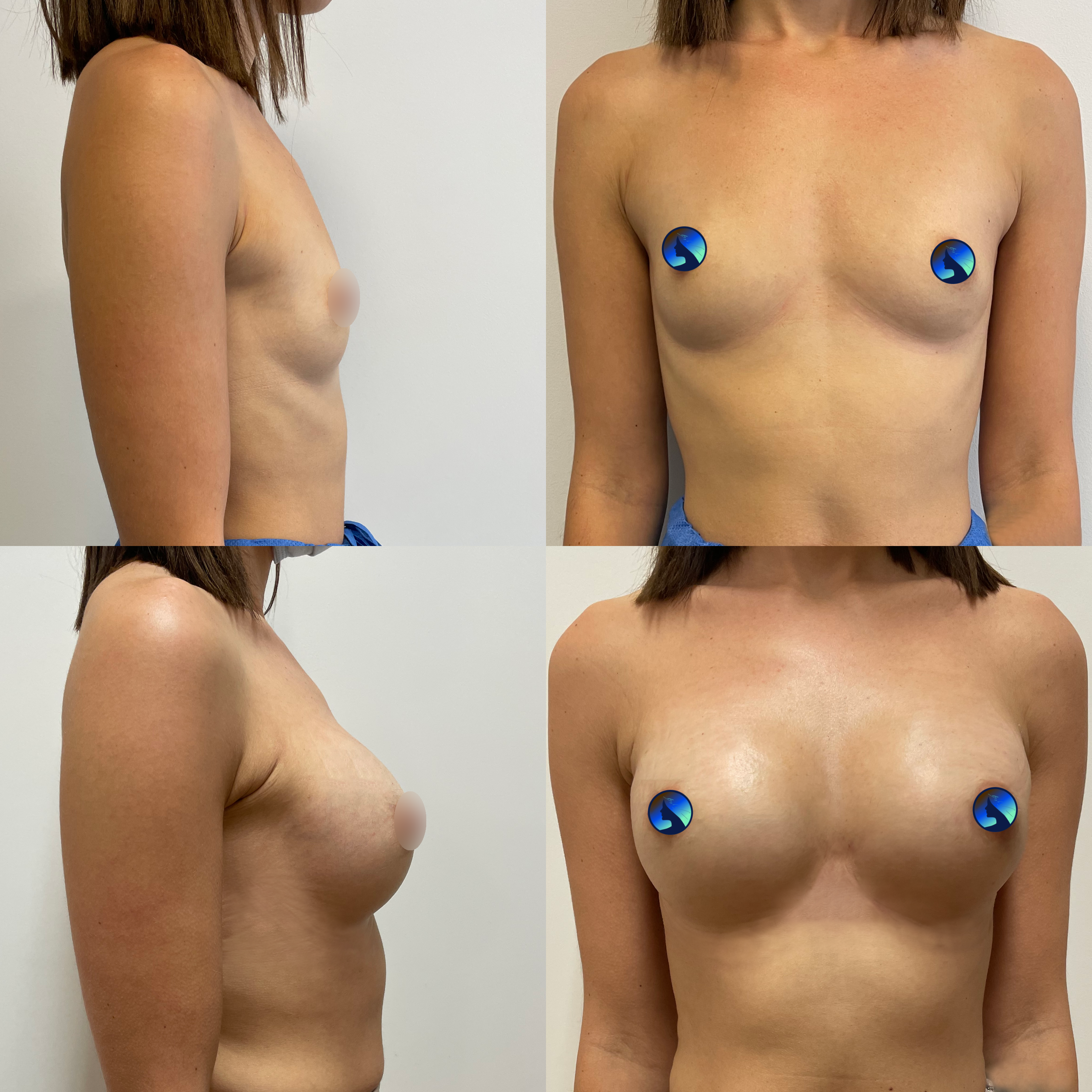 Transaxillary breast augmentation before and after