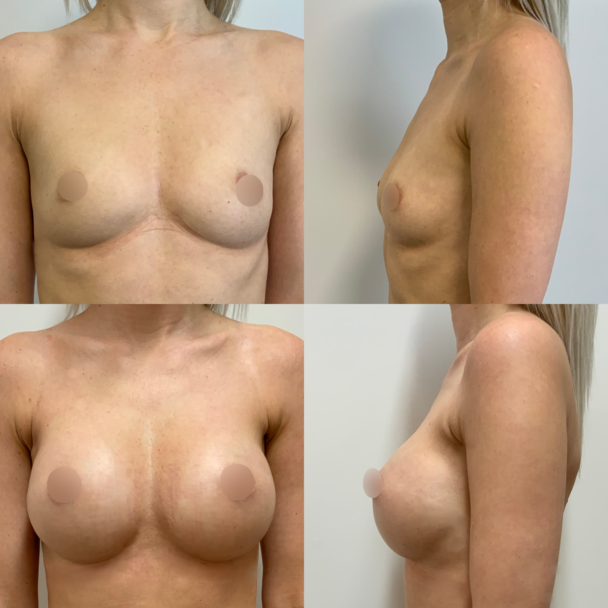 Transaxillary landing page