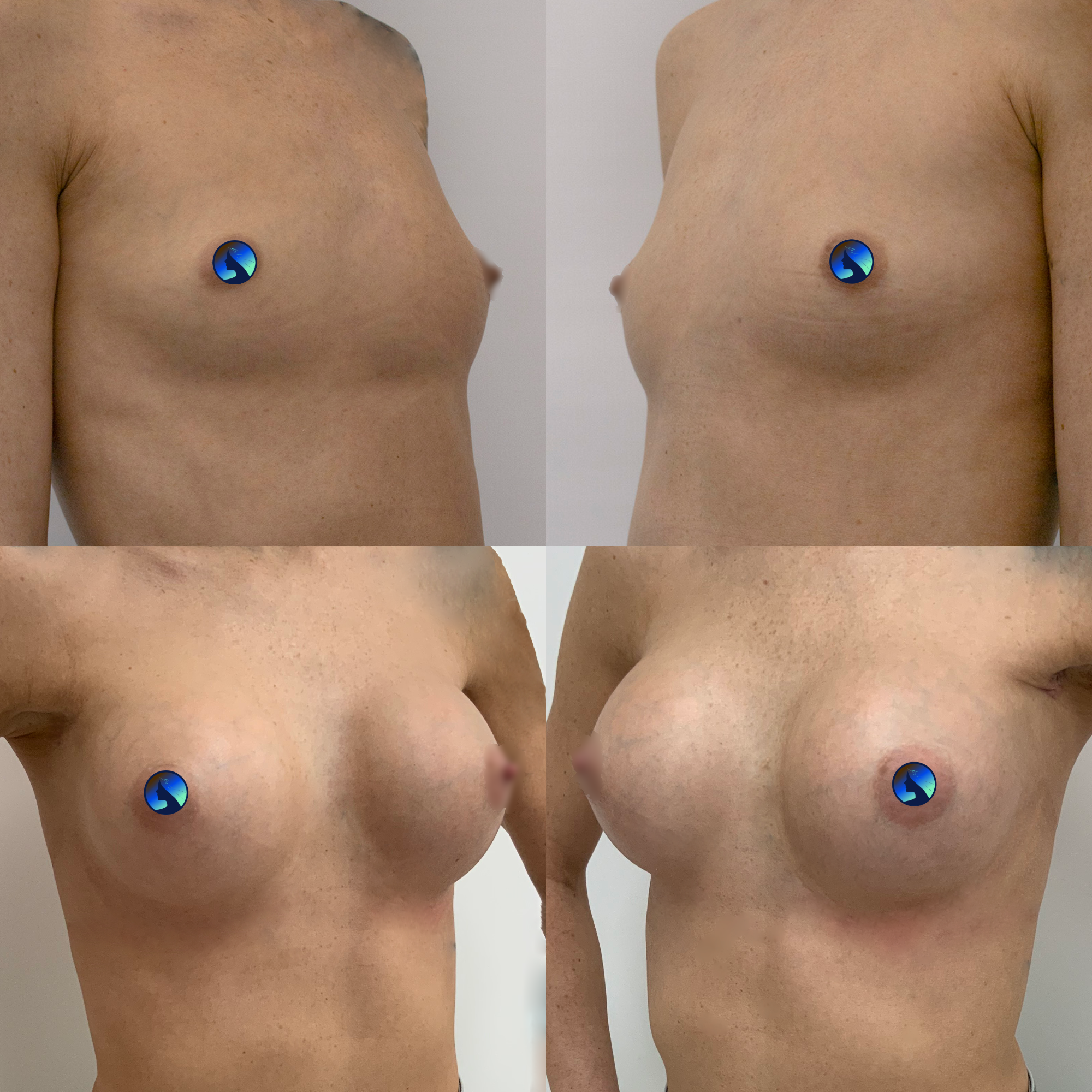 a very subtle transaxillary breast augmentation