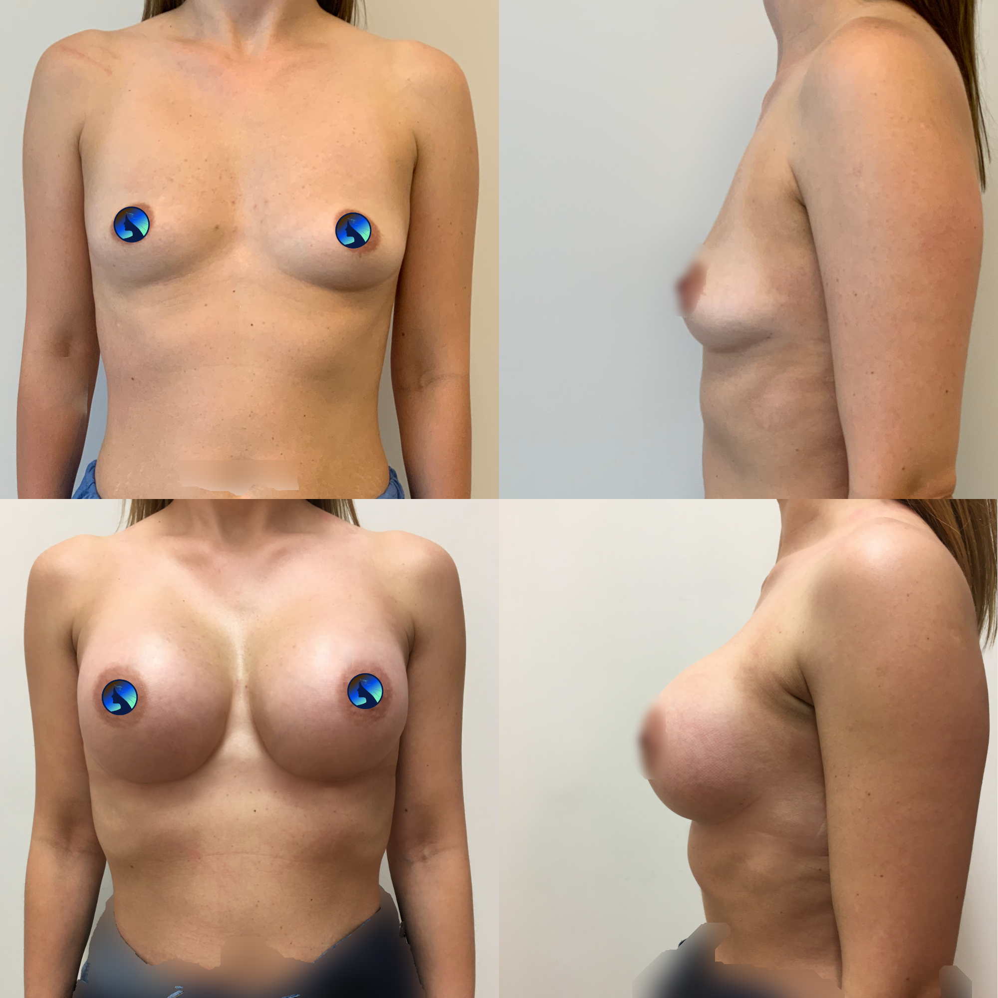 a very subtle transaxillary breast augmentation