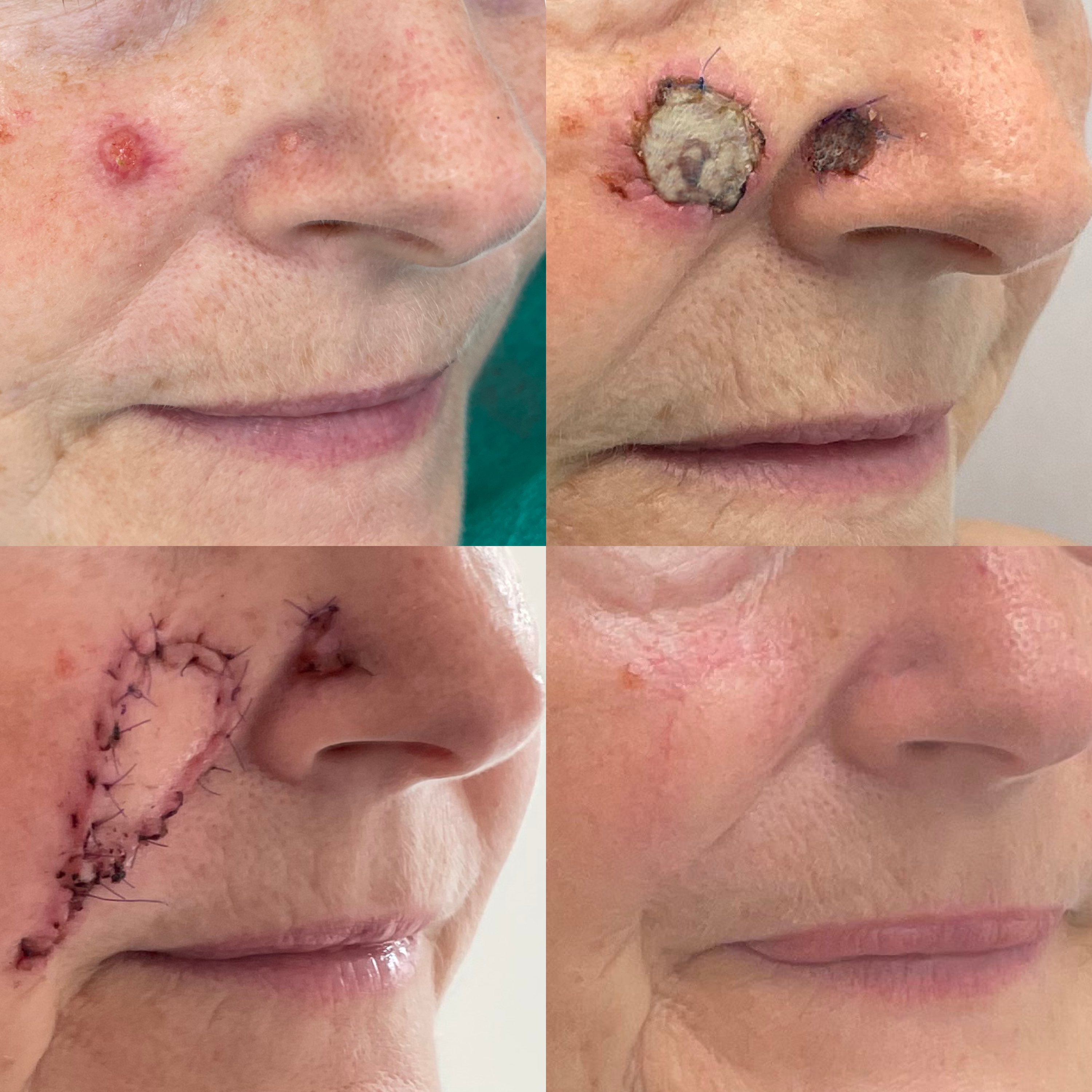 cheek and nose reconstruction